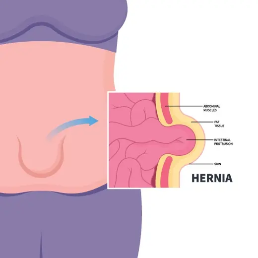 hernia images