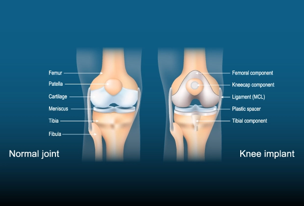 know-more-about-Knee Replacement-treatment-in-Kolar