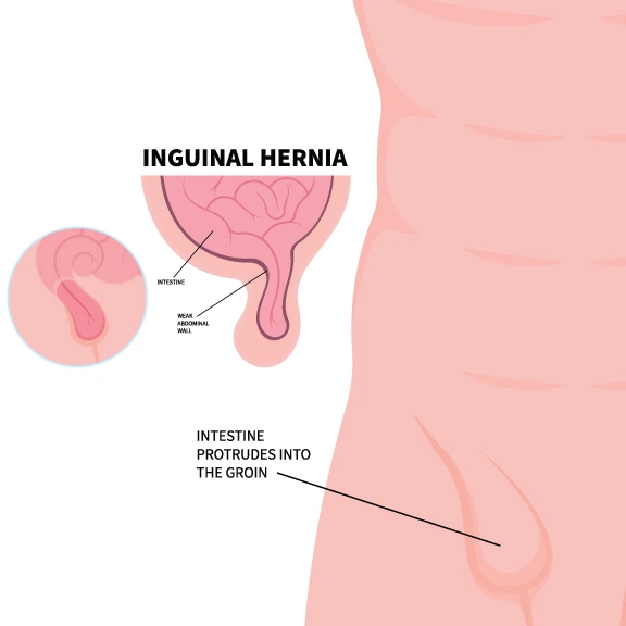 hernia images in male