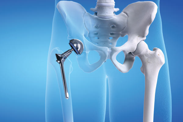 Doctor holding hip replacement implant used in hip replacement