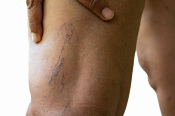Diagnosis for Deep Vein thrombosis