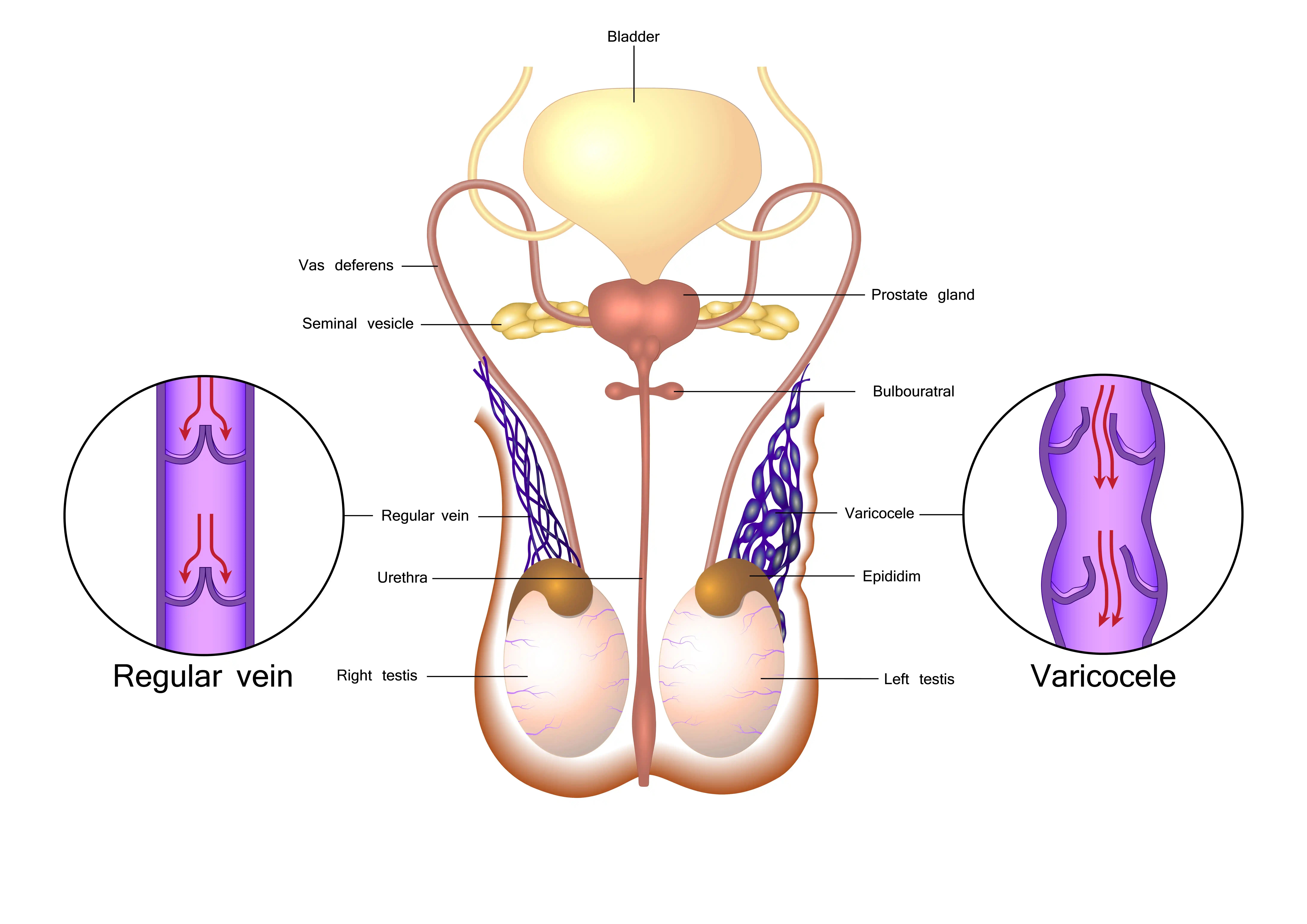 Varicocele