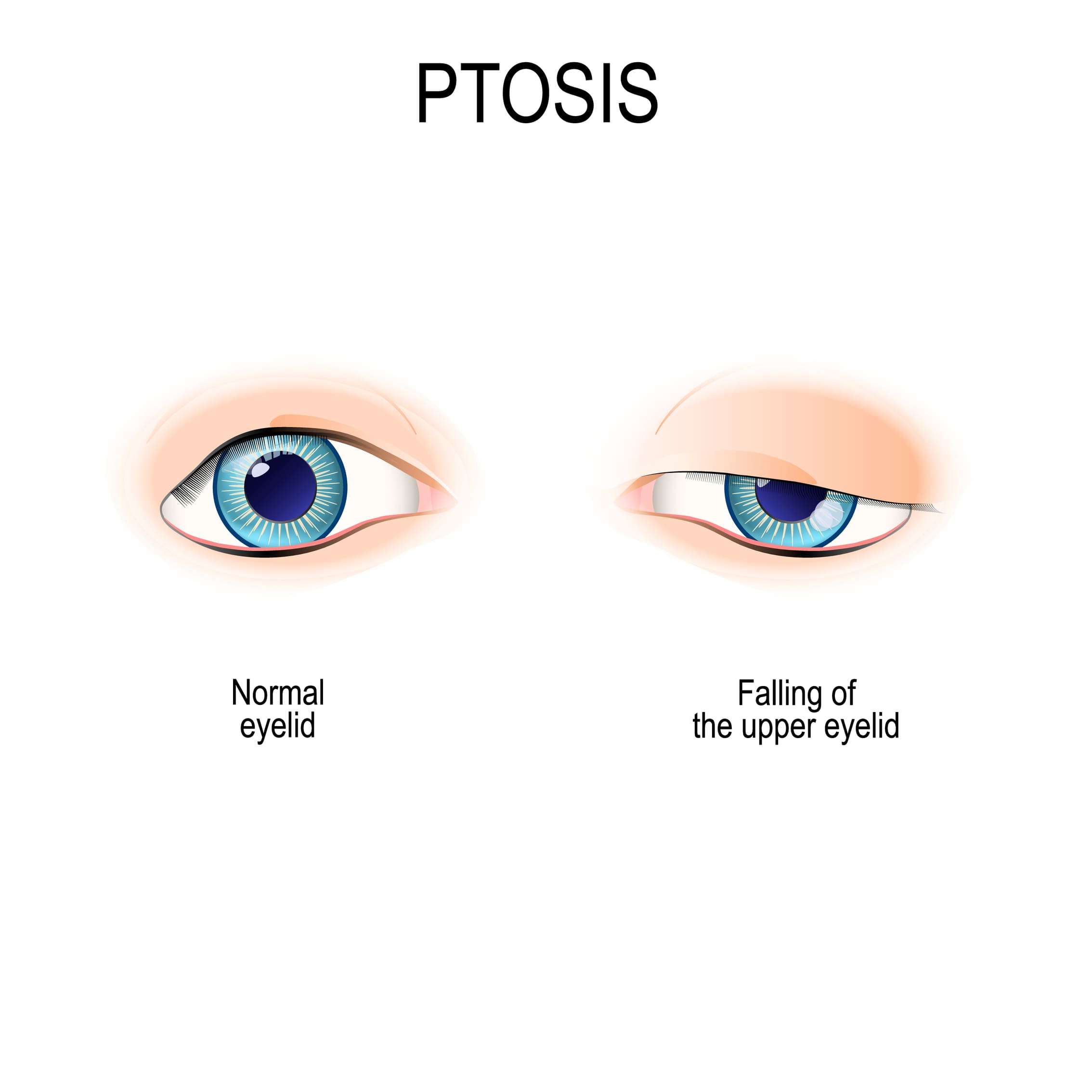 ptosis