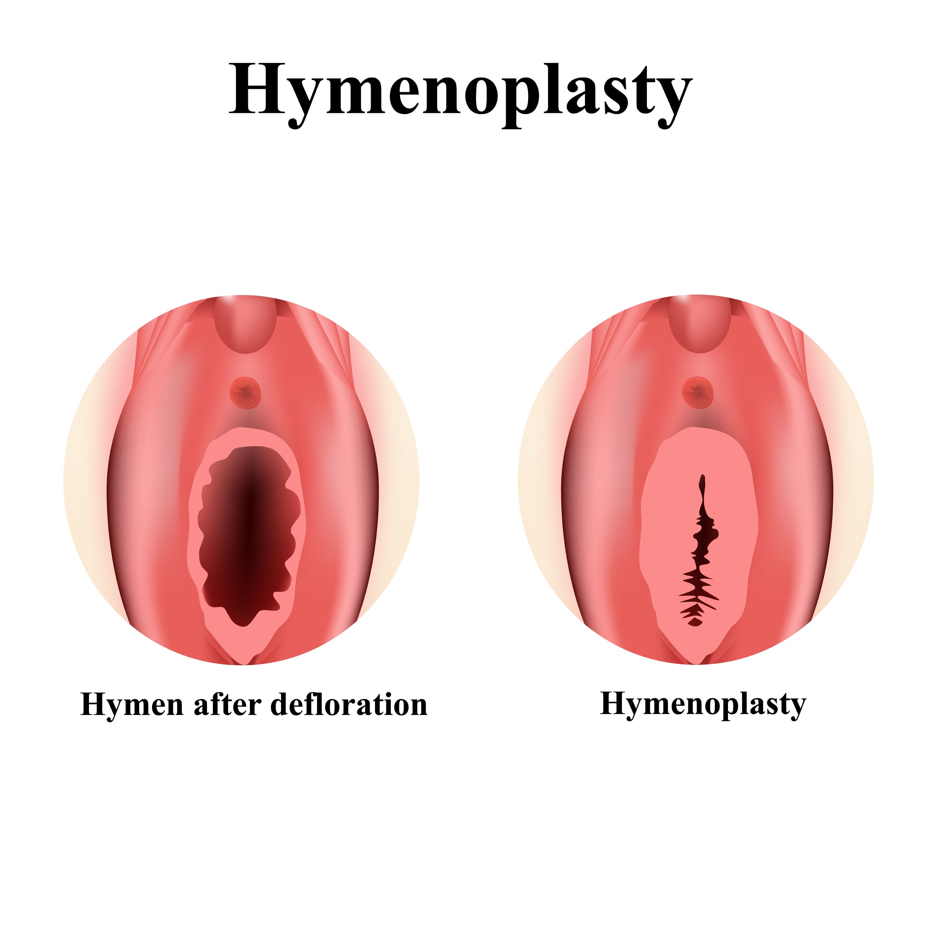 Hymenoplasty