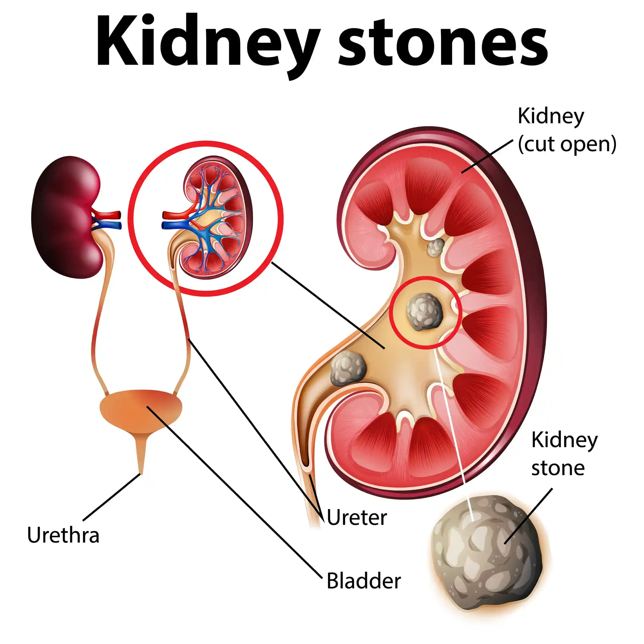 Kidney-Stones