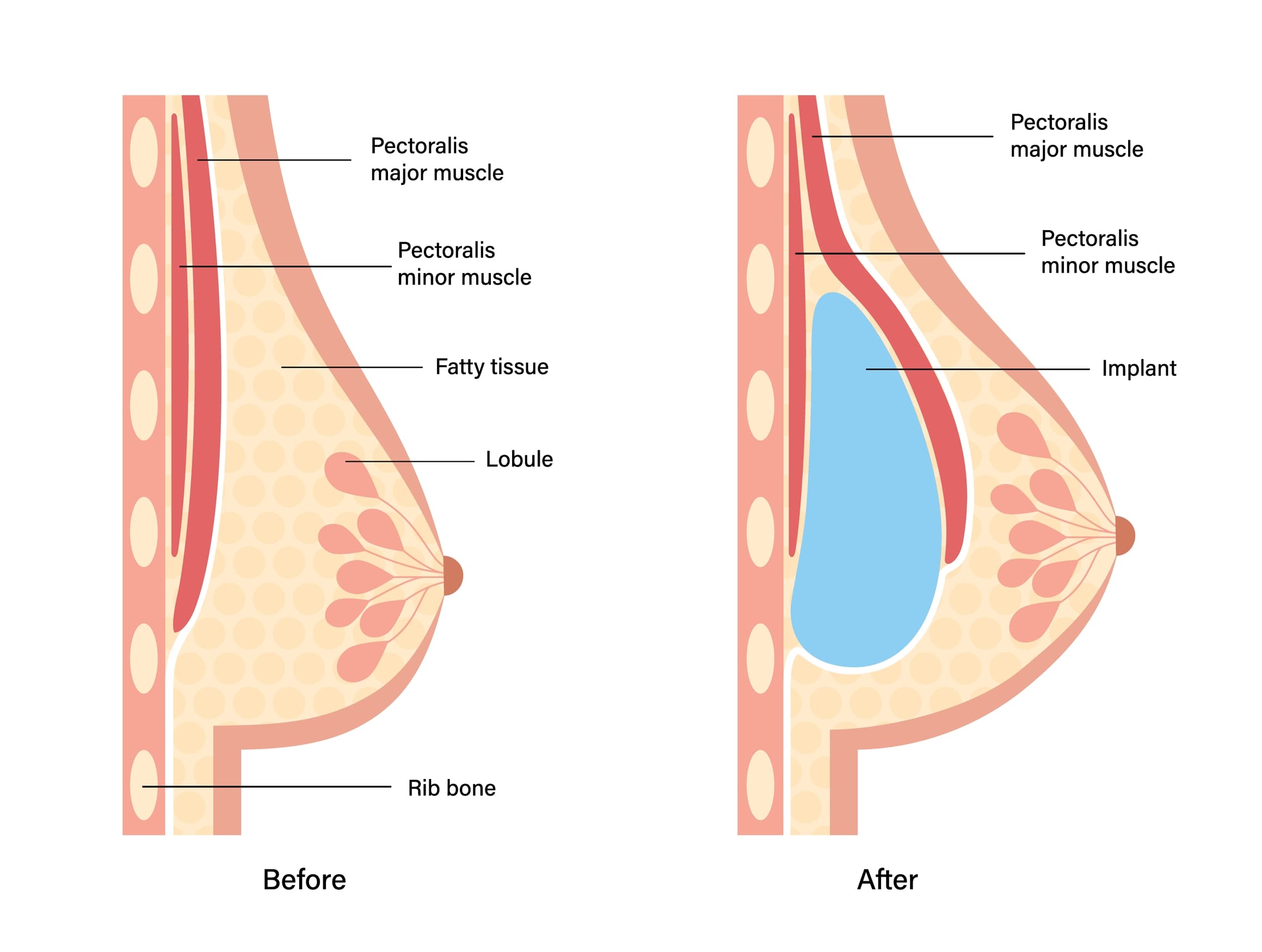 Breast-Surgery