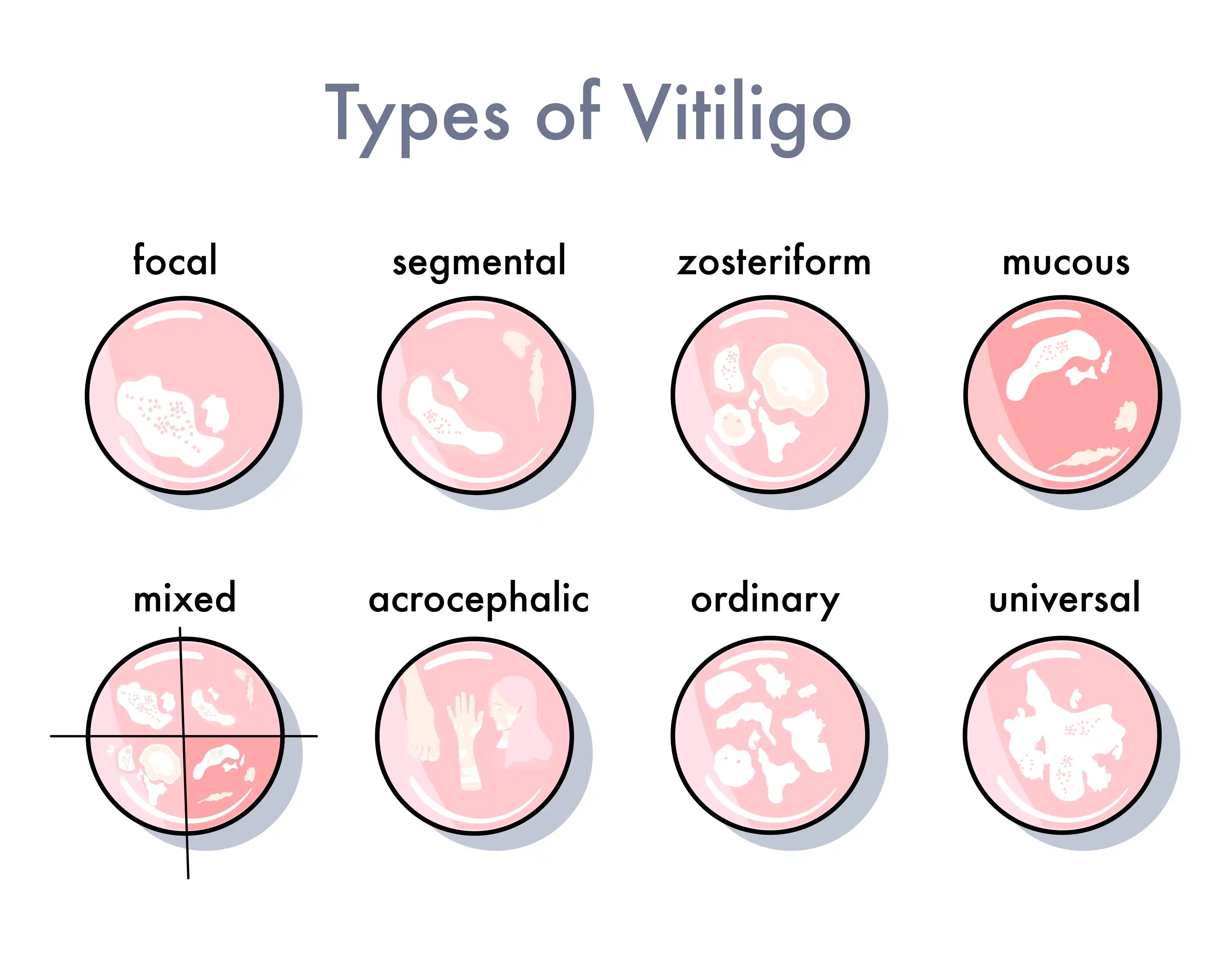 vitiligo