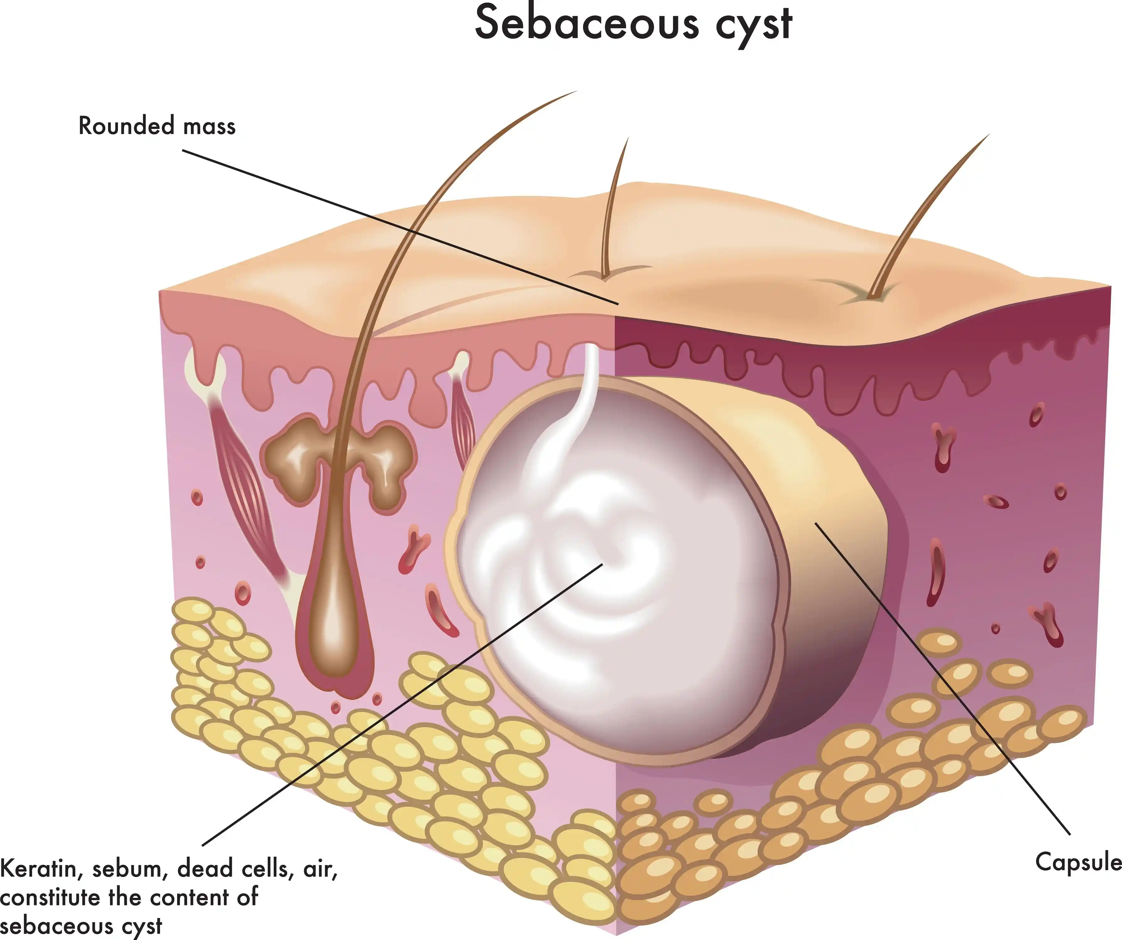 Sebaceous-Cyst