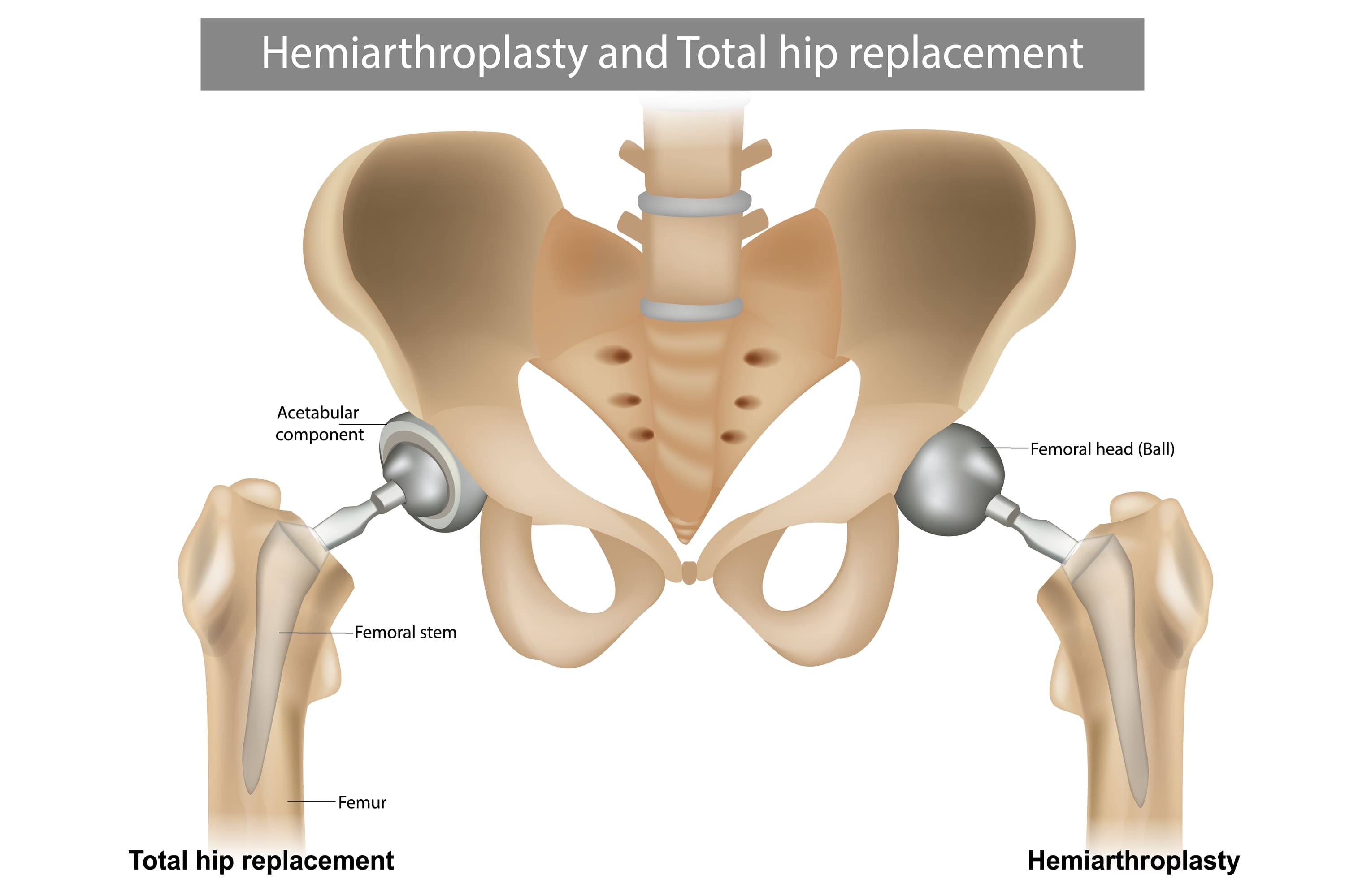 Revision-Hip-Replacement