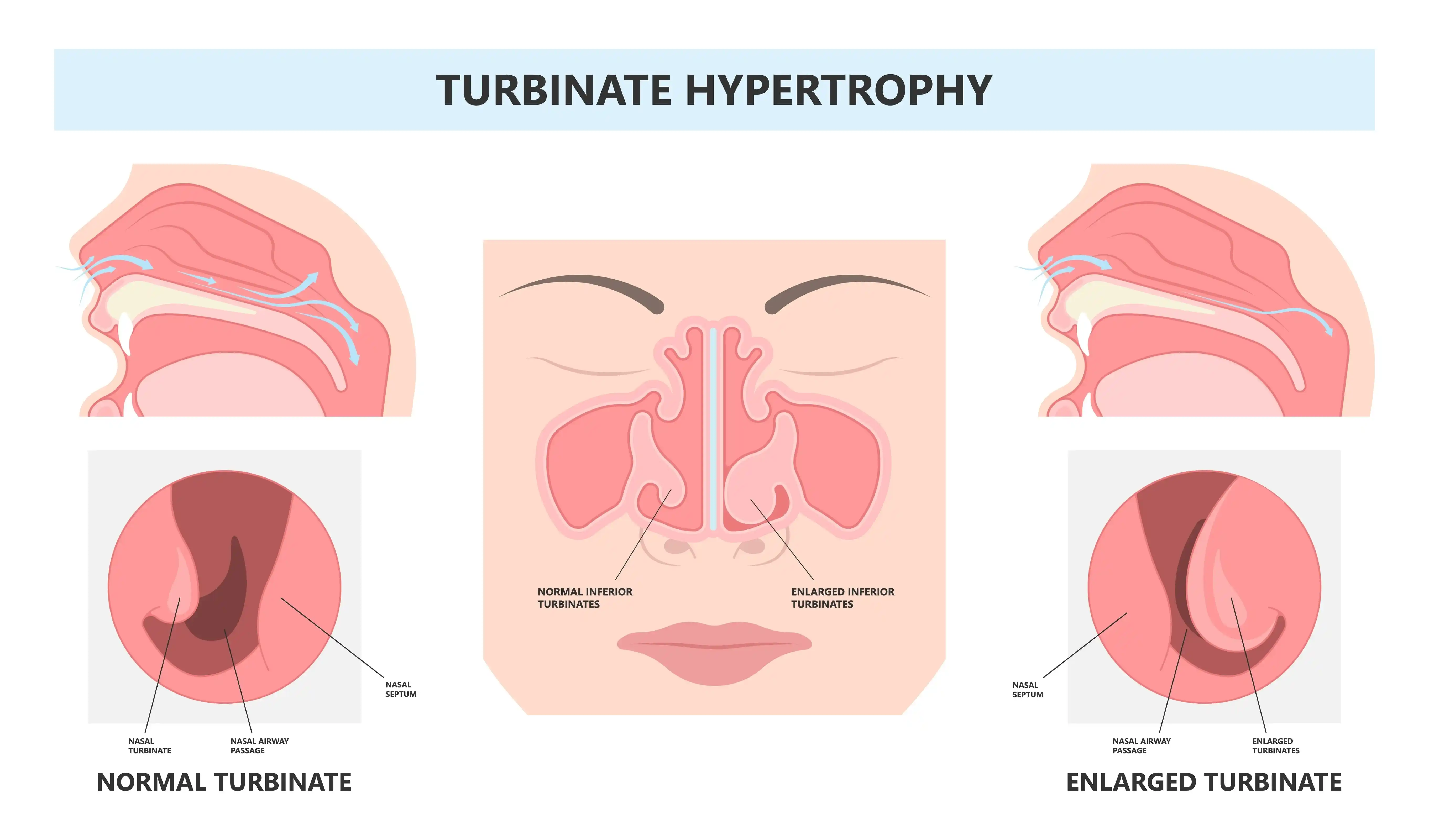 Turbinate-Reduction