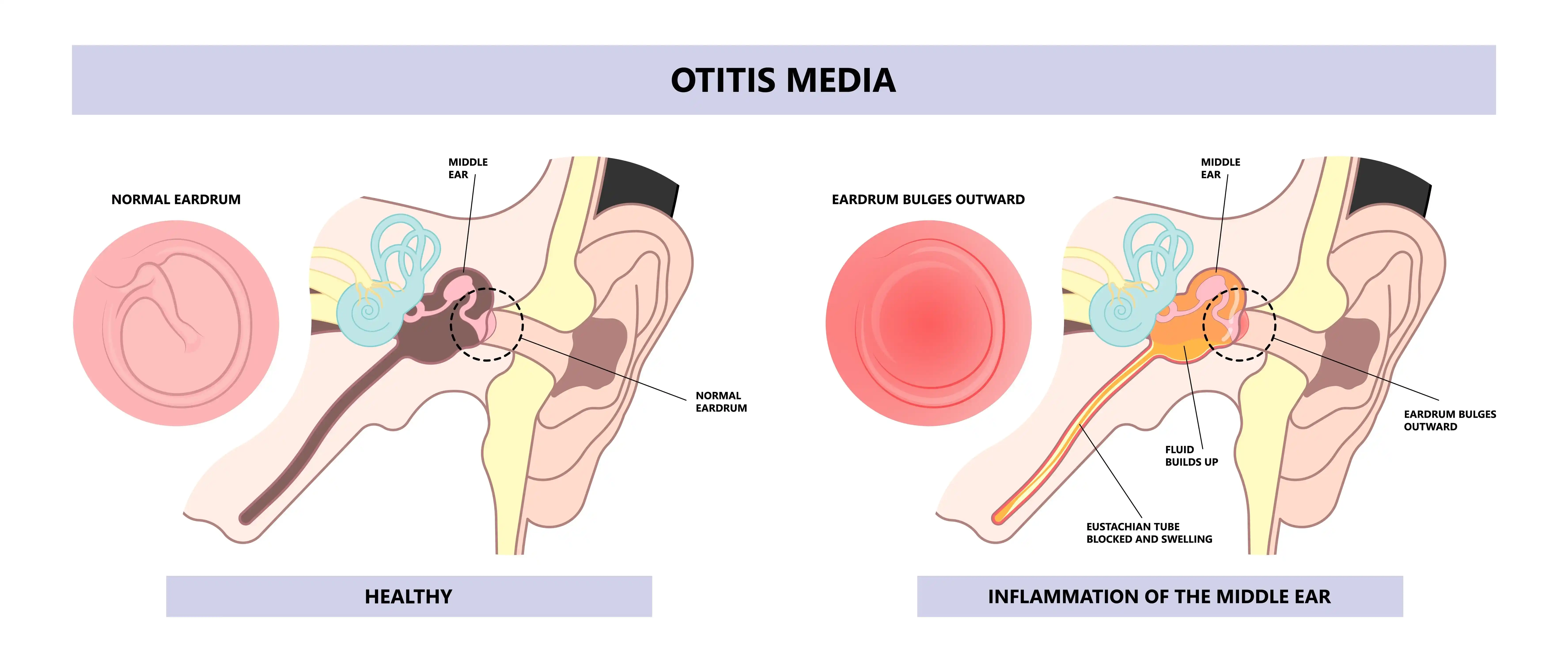Otitis-Media