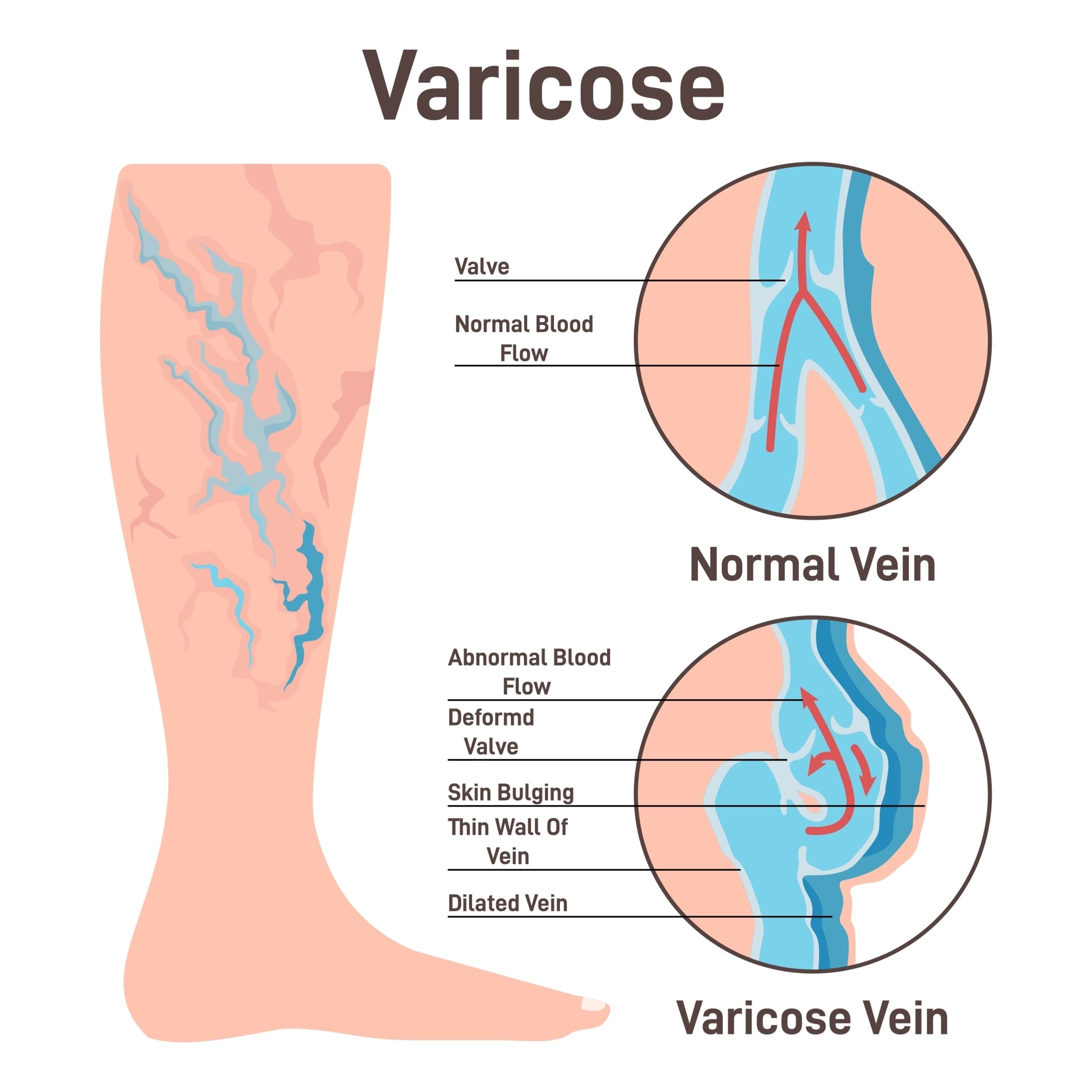 Varicose-Veins