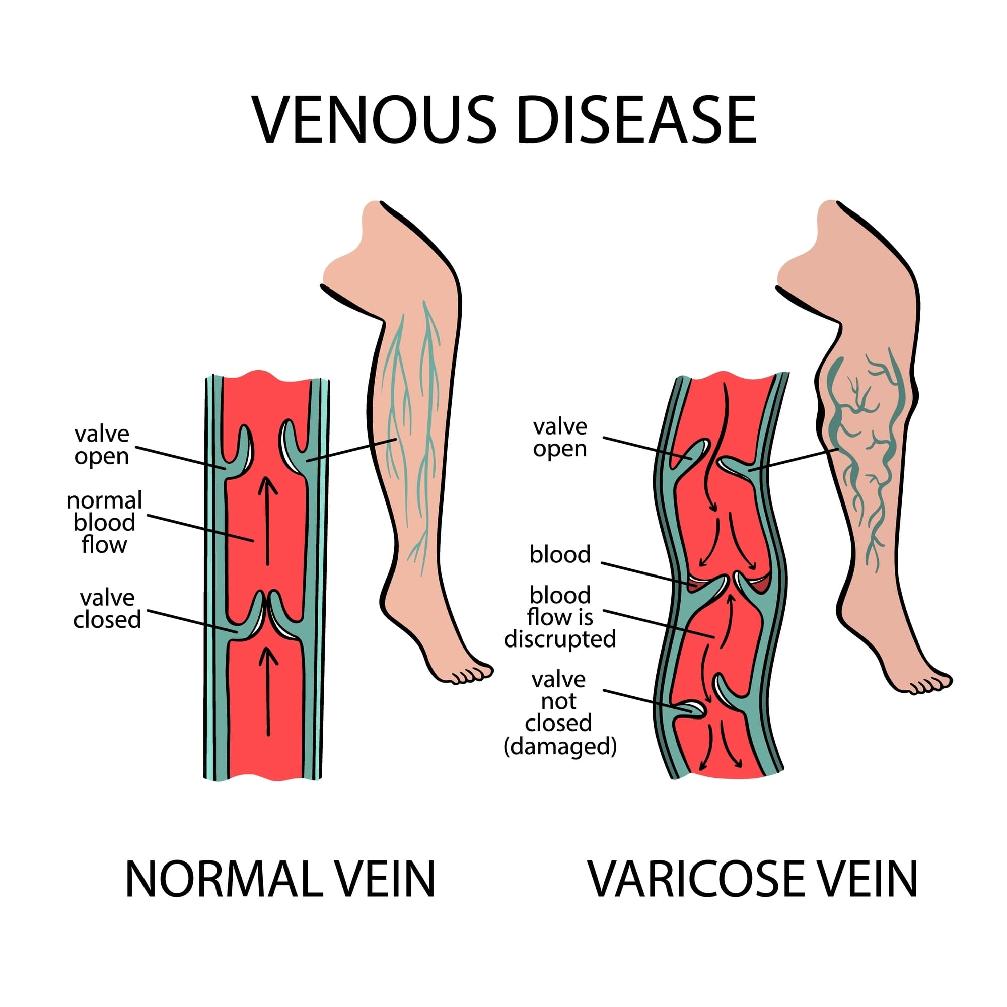 Spider-Veins