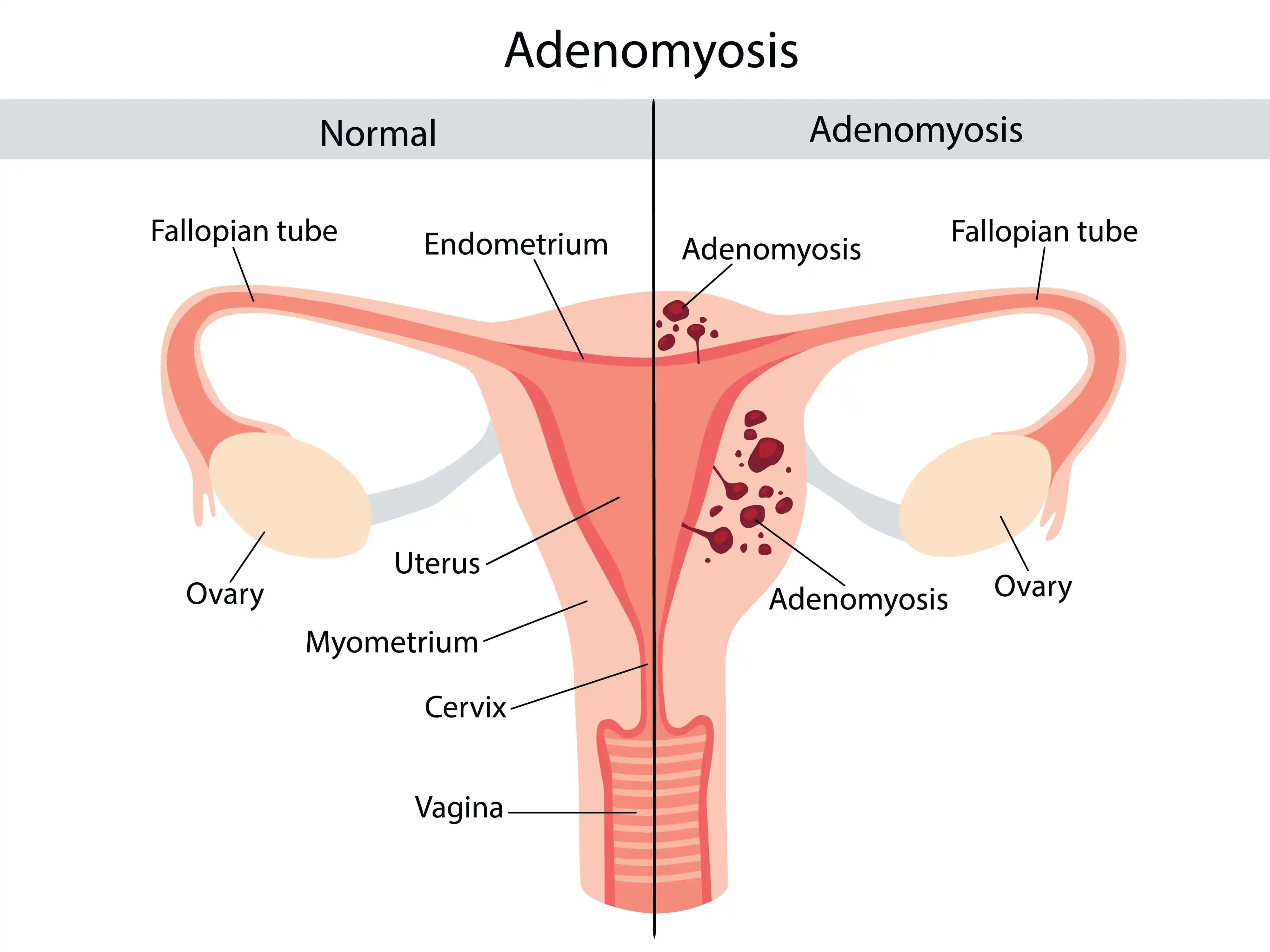 Adenomyosis