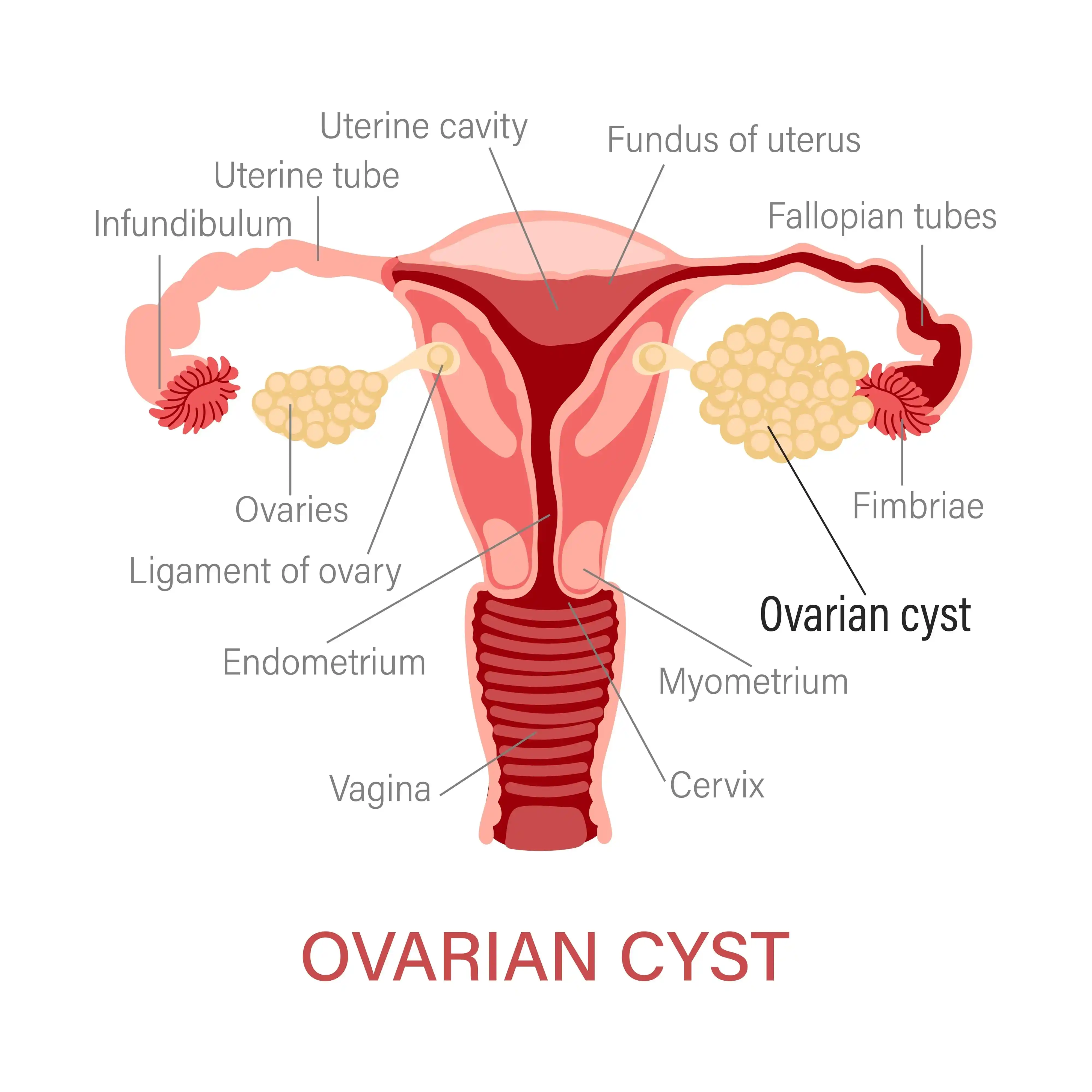 Ovarian-Cyst