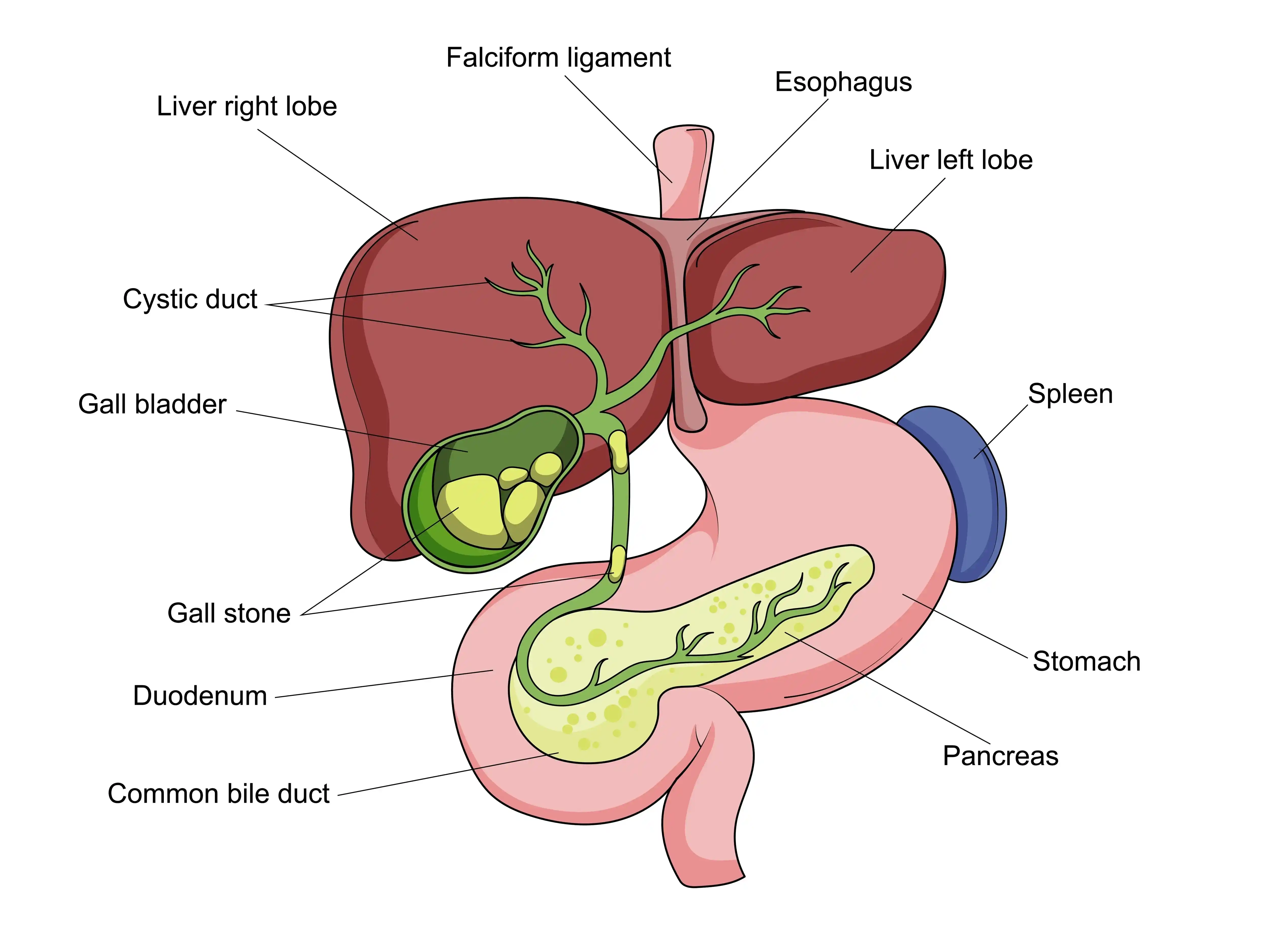 Gallstone