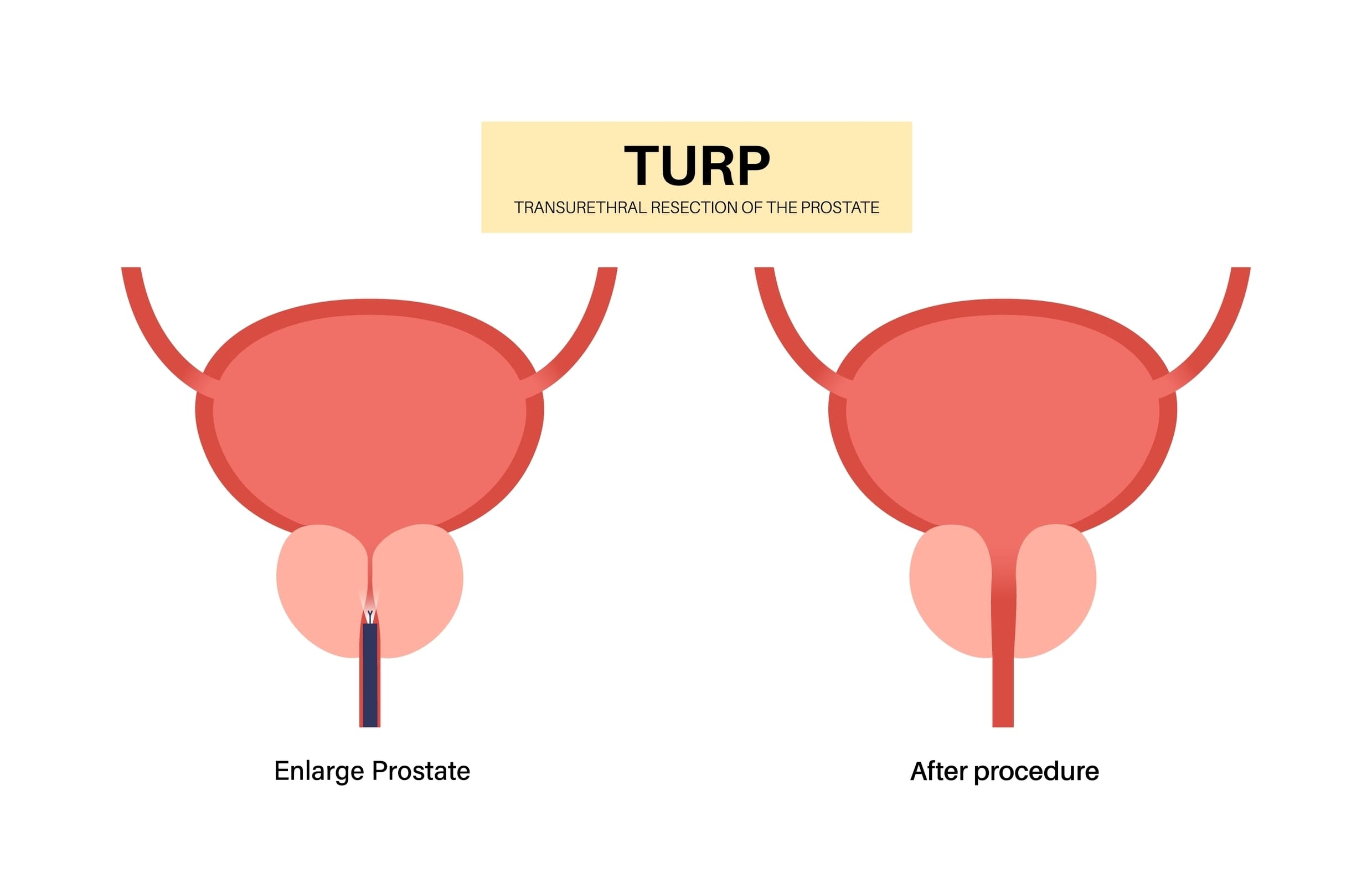 Transurethral-Resection-Prostate-Turp