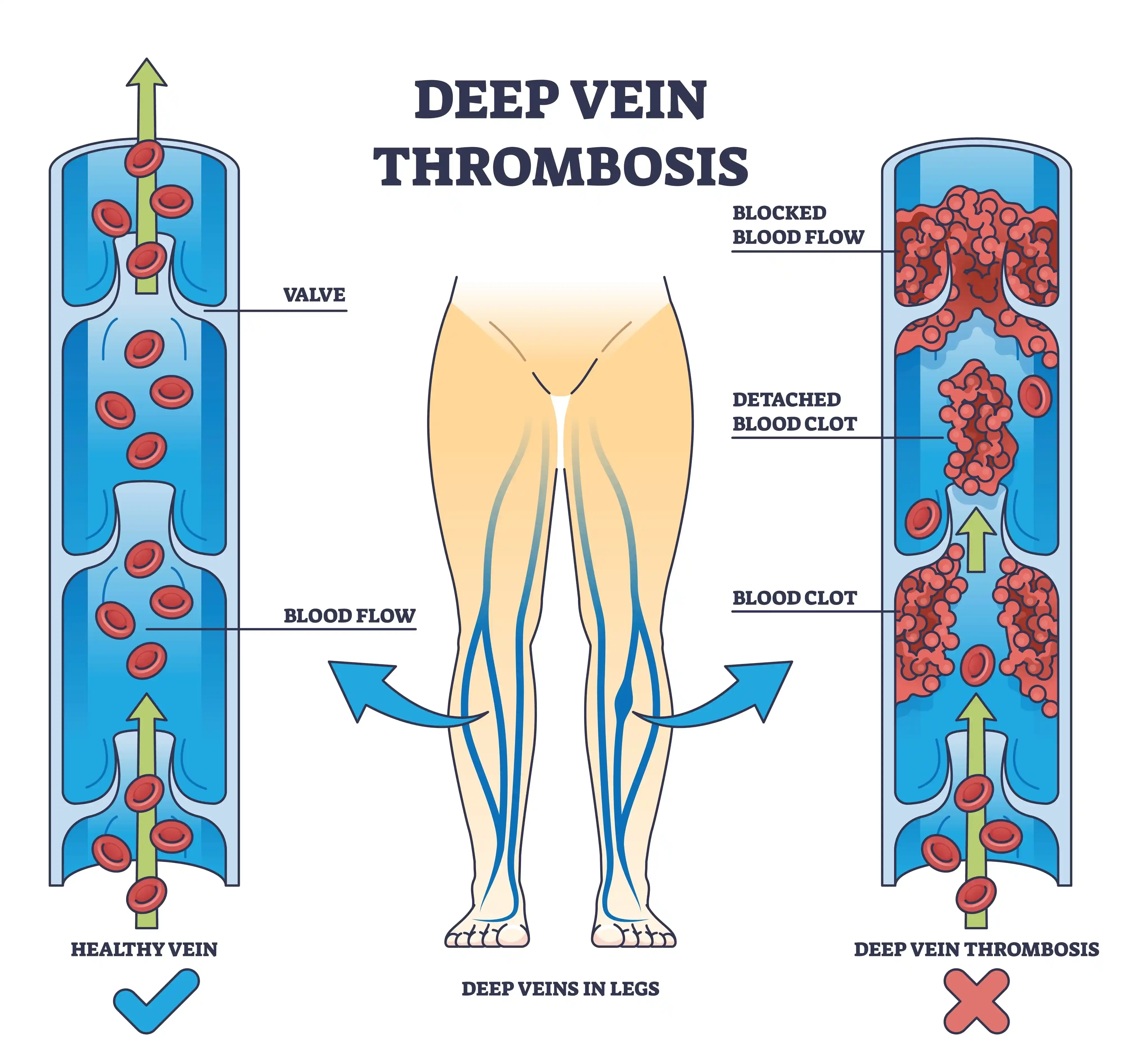 Deep-Vein-Thrombosis