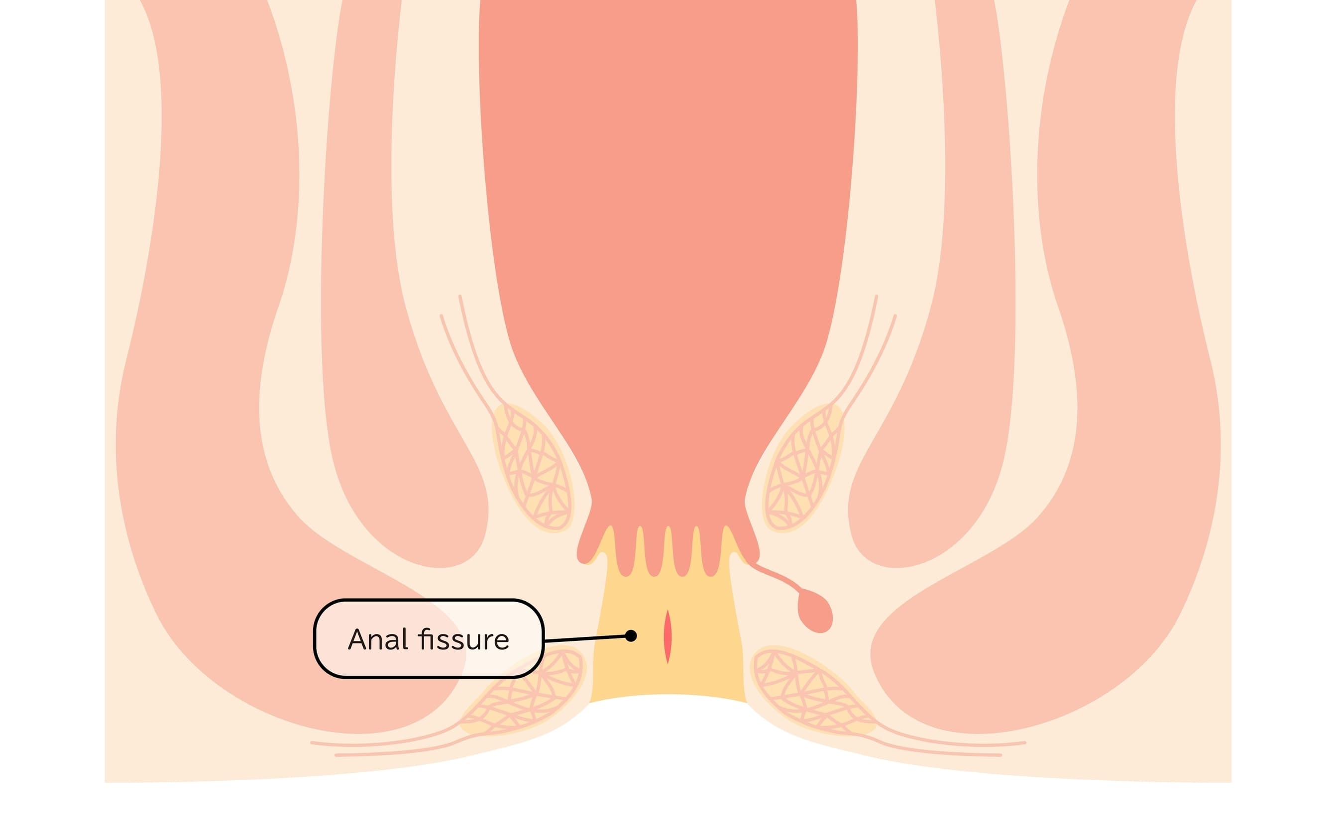 Fissure