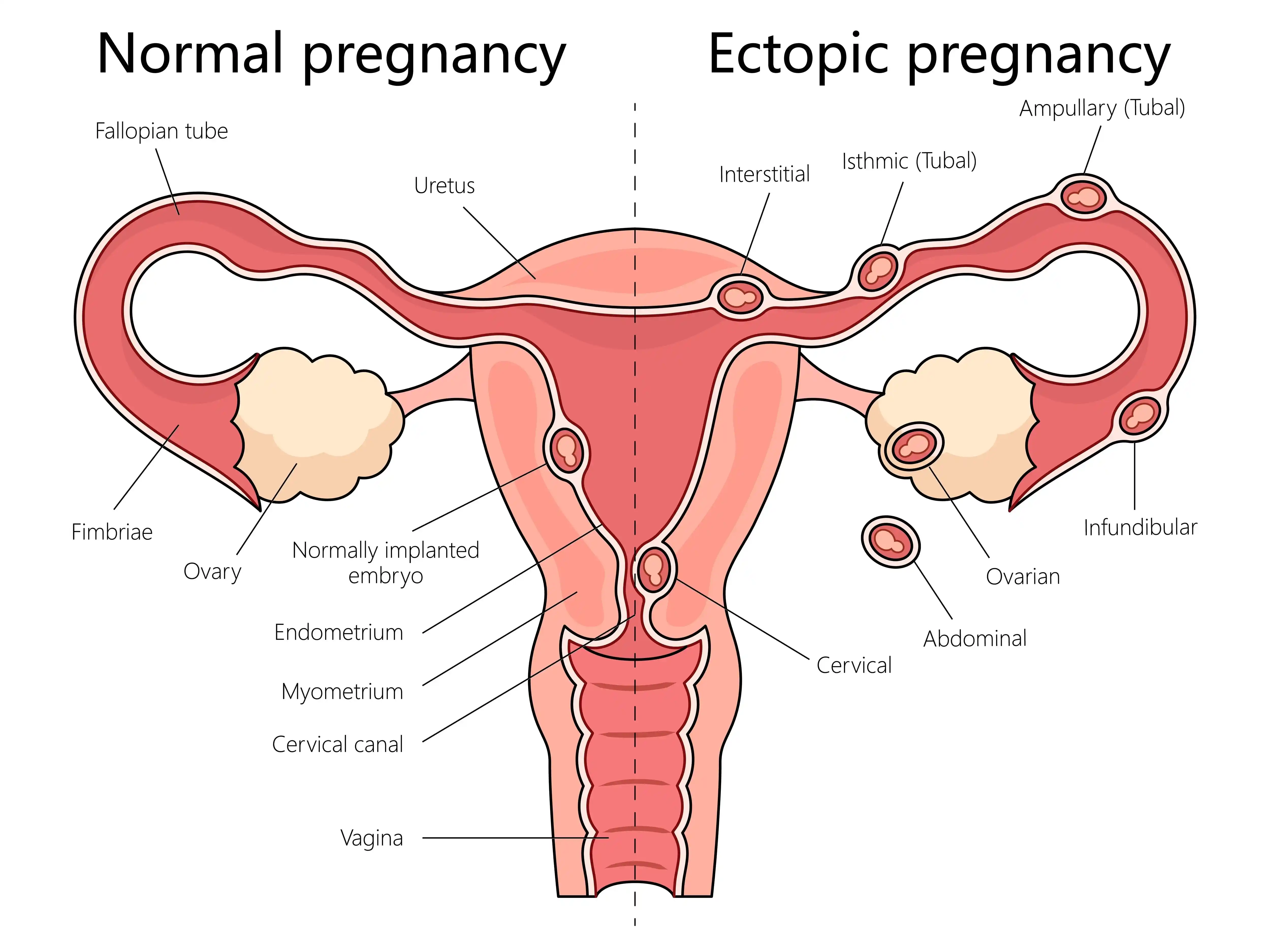 Ectopic-Pregnancy