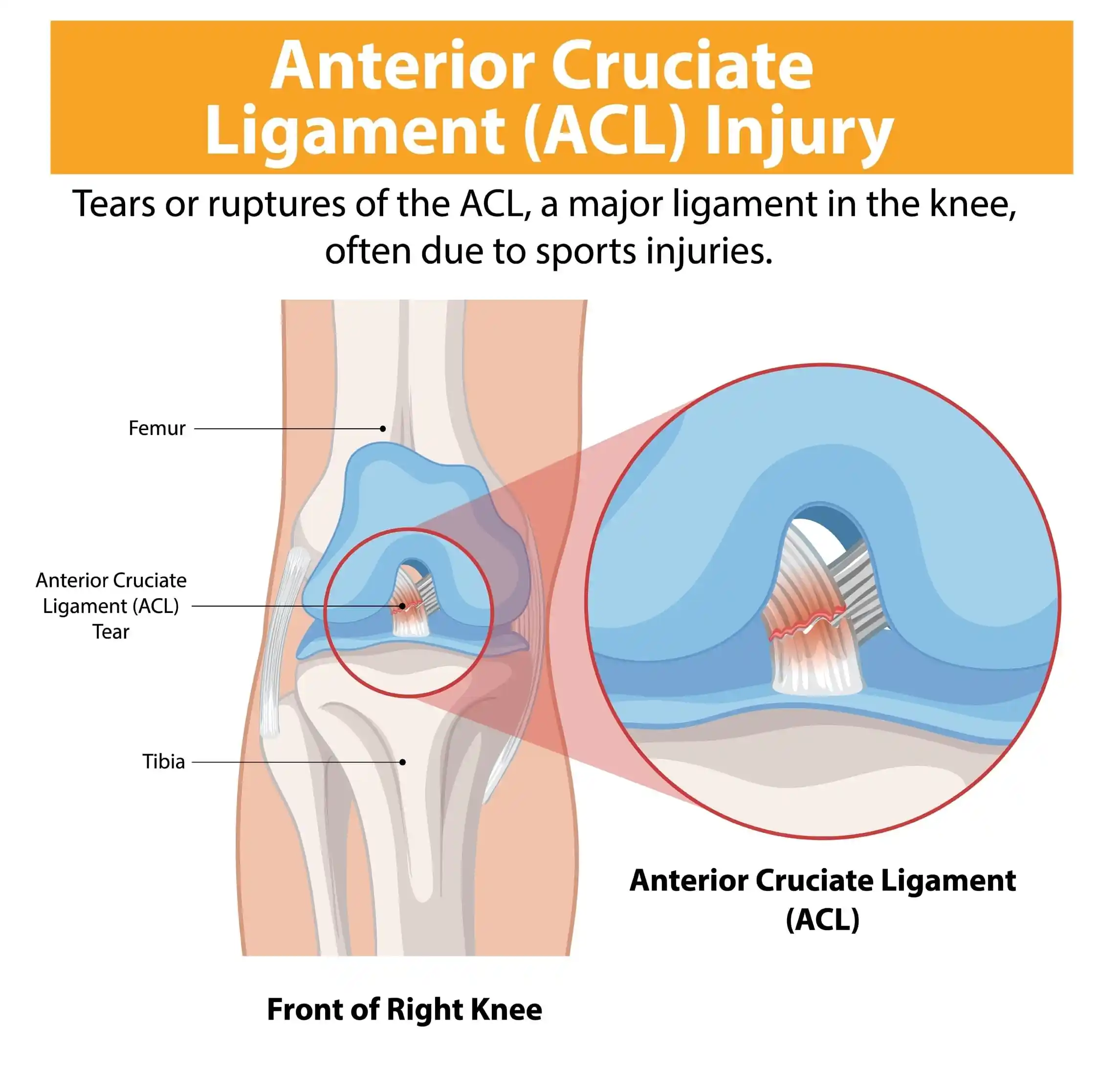 acl-reconstruction