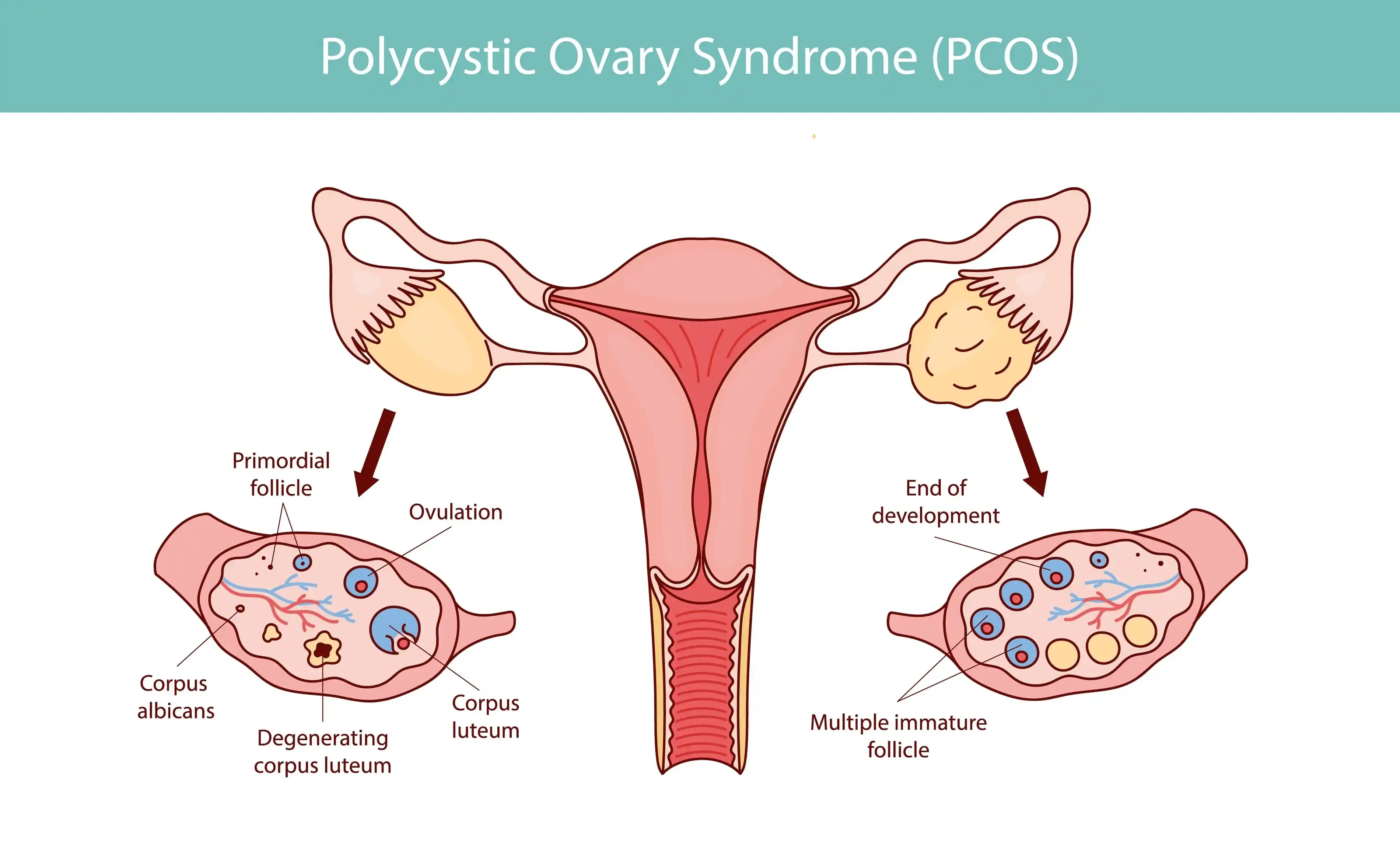 Pcos-Pcod