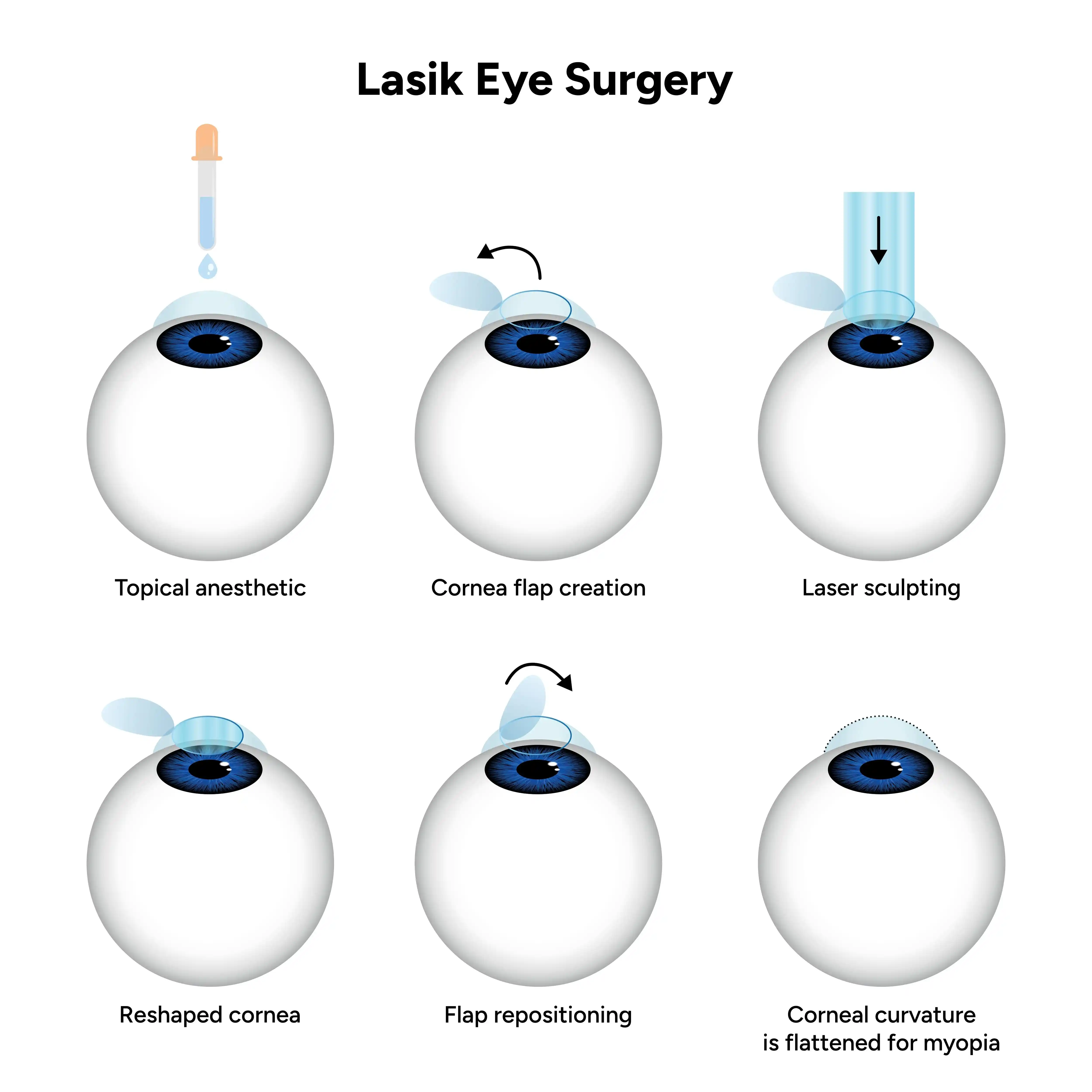 Lasik-Eye-Surgery