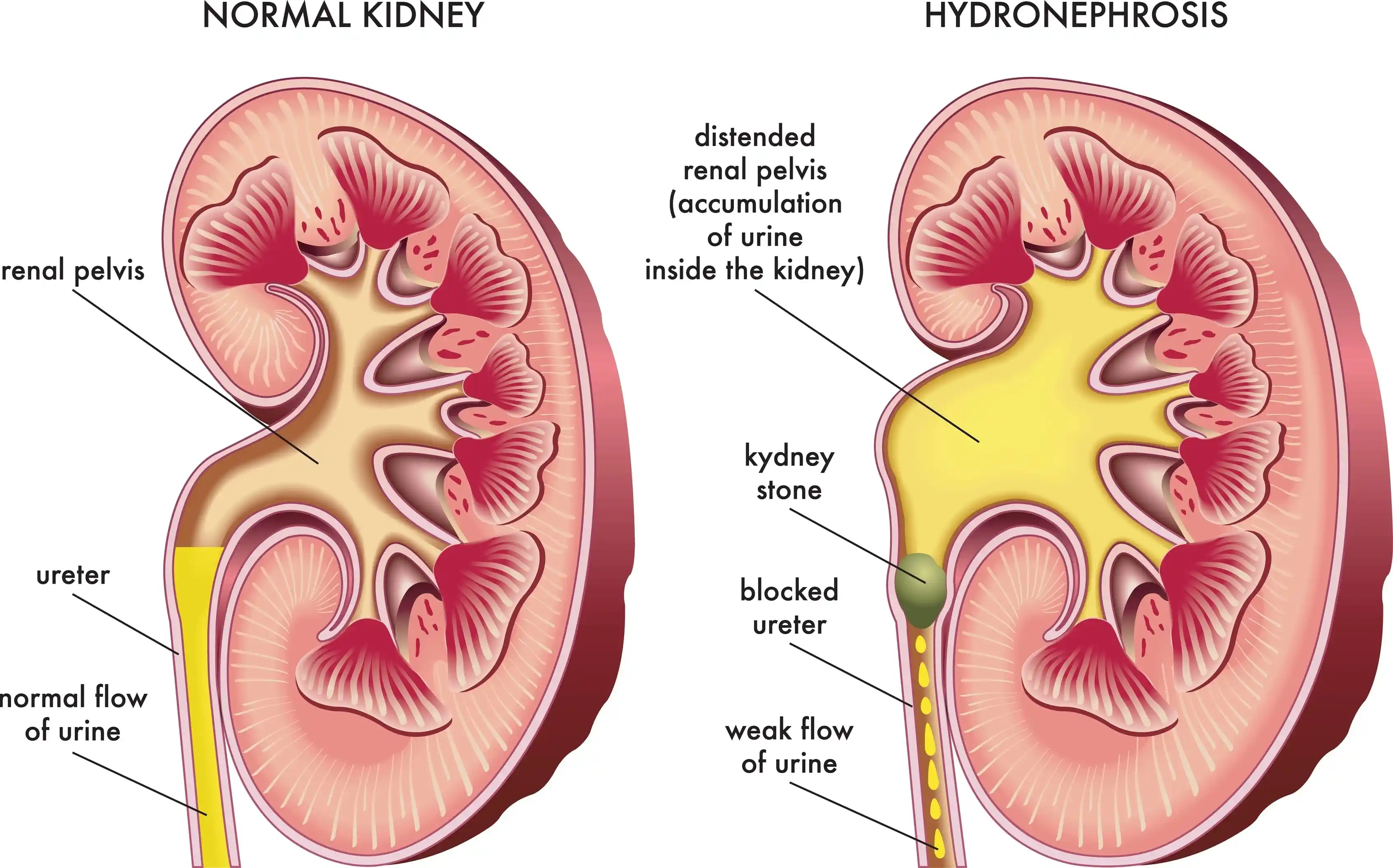 Hydronephrosis