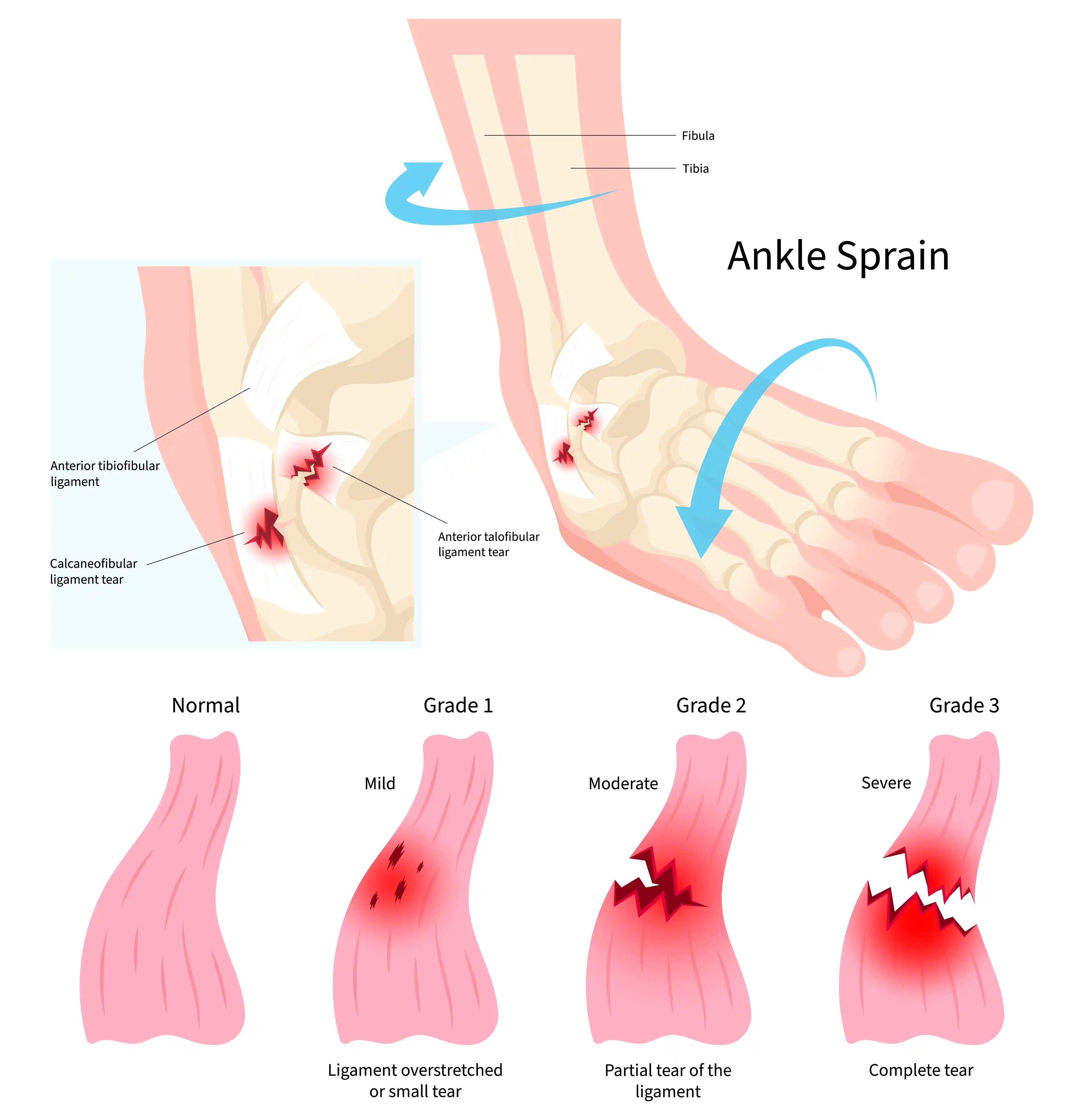 ankle-ligament-injury