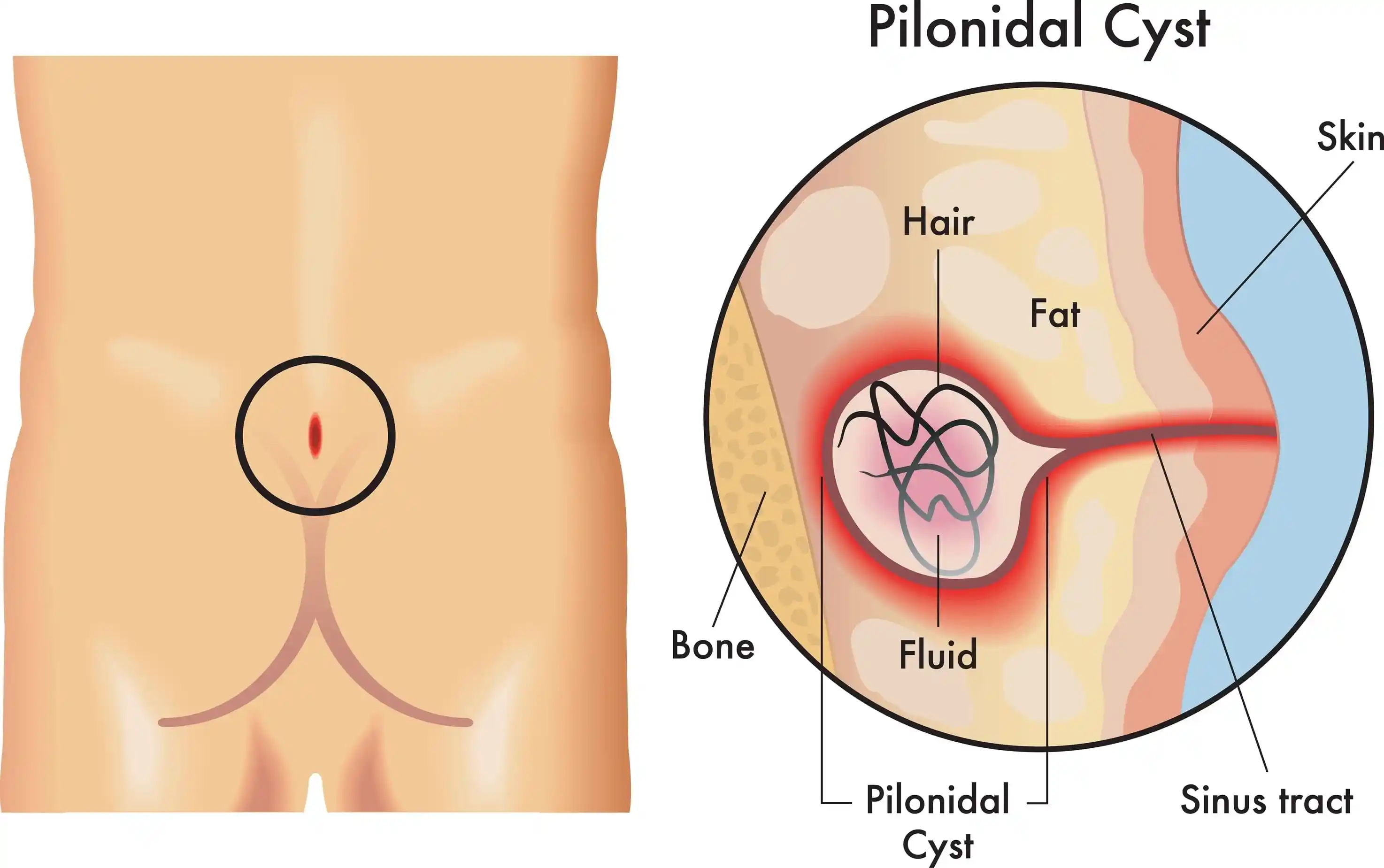 Pilonidal-Sinus