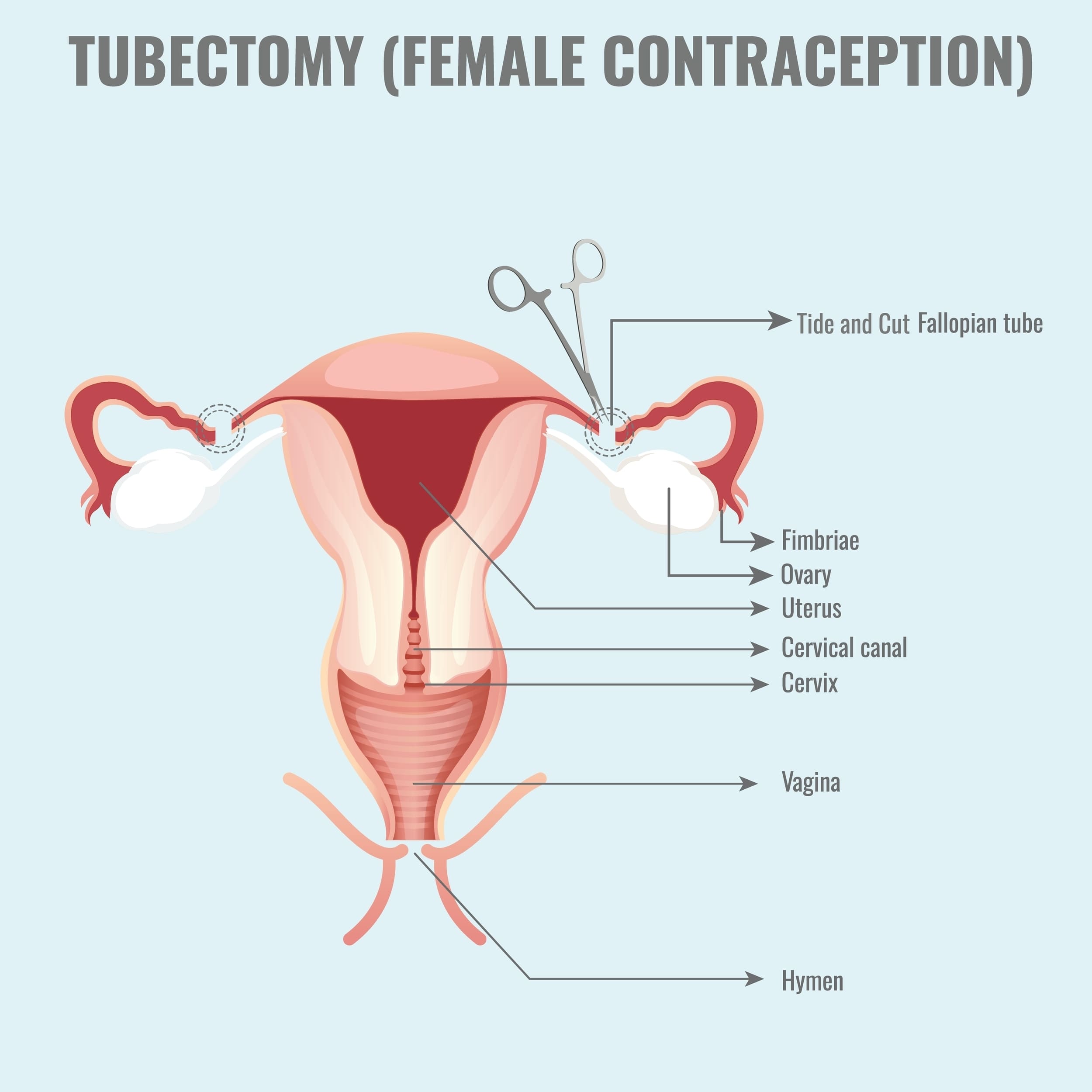 tubectomy