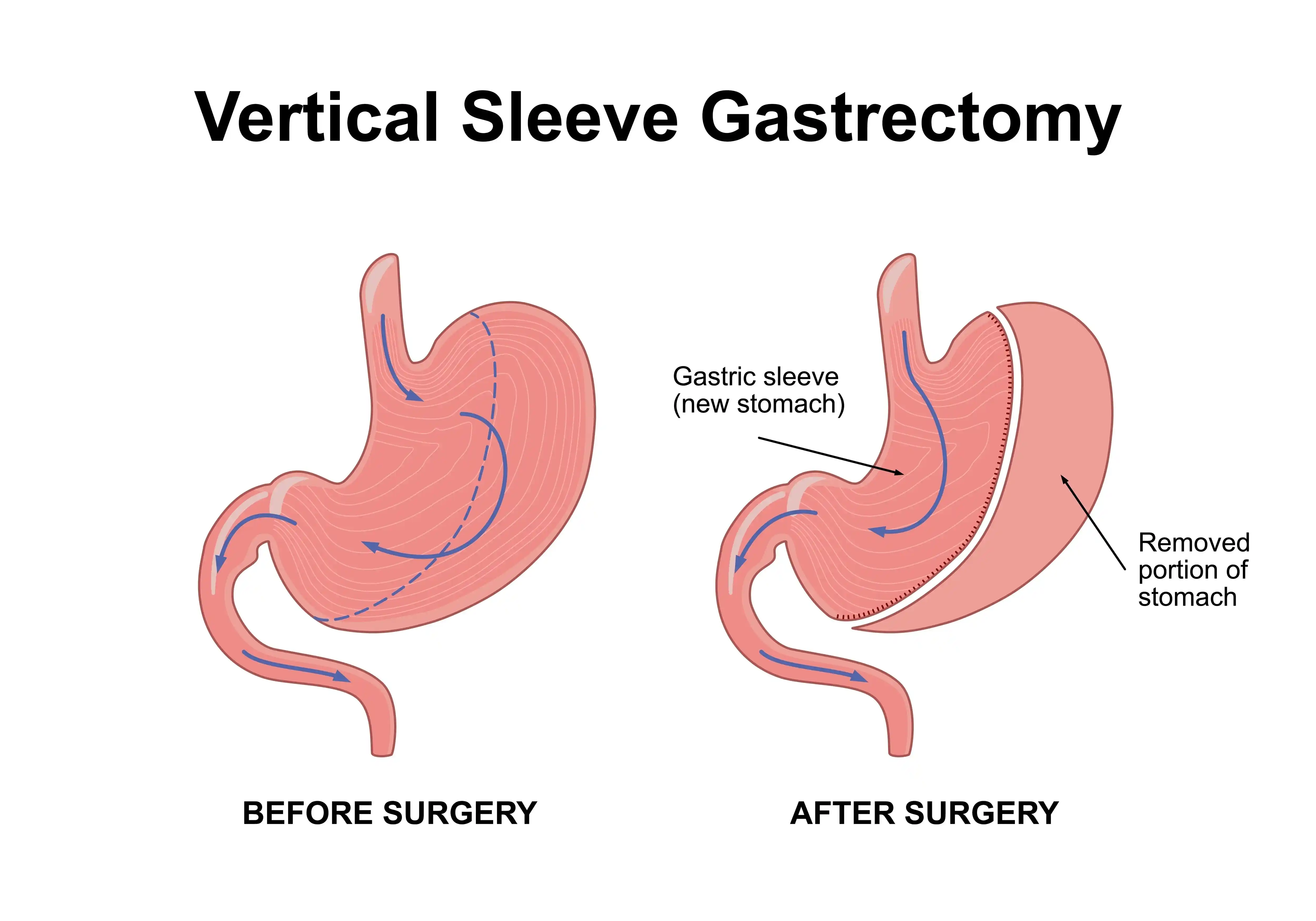 Bariatric-Surgery