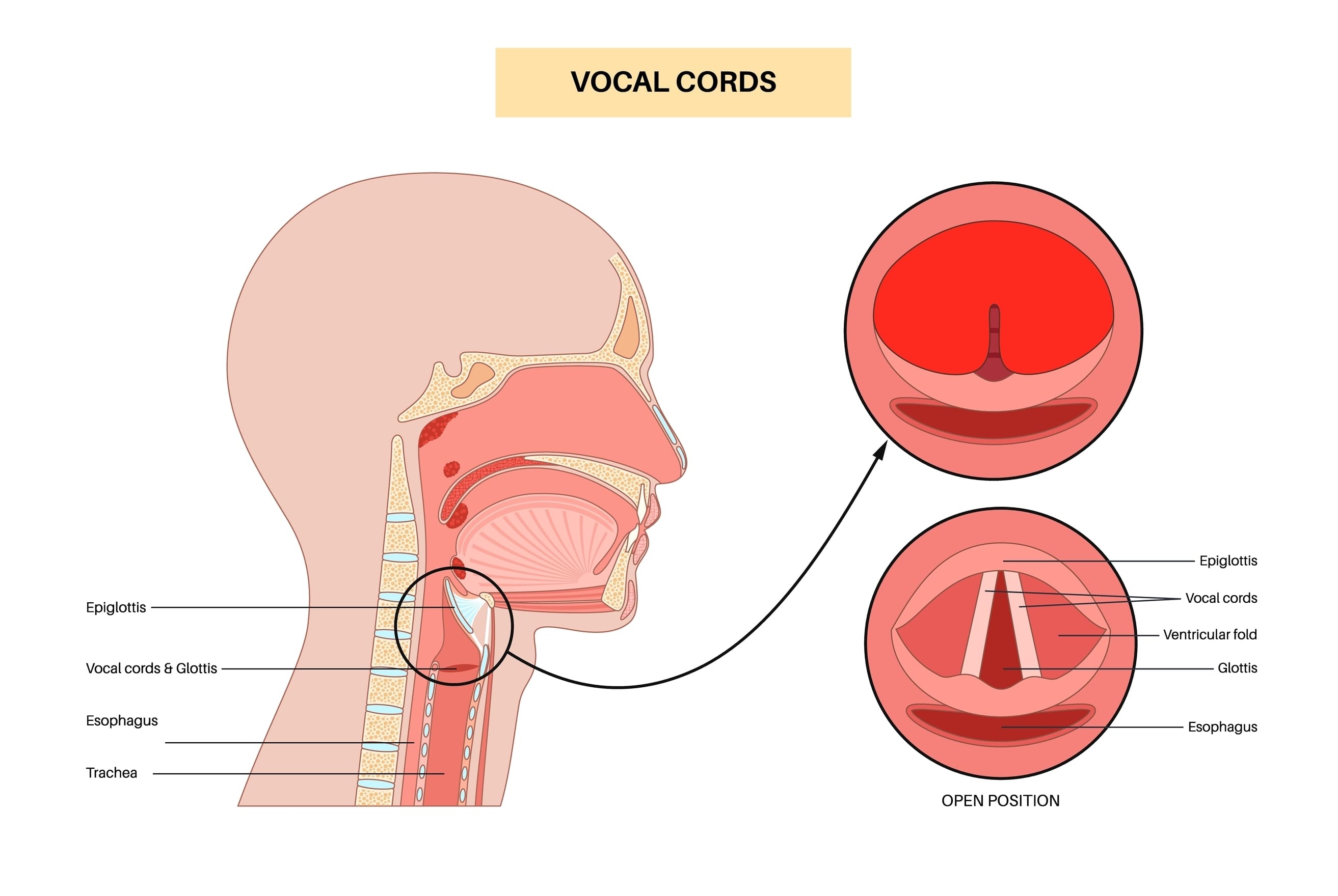 Vocal-Cord-Polyps