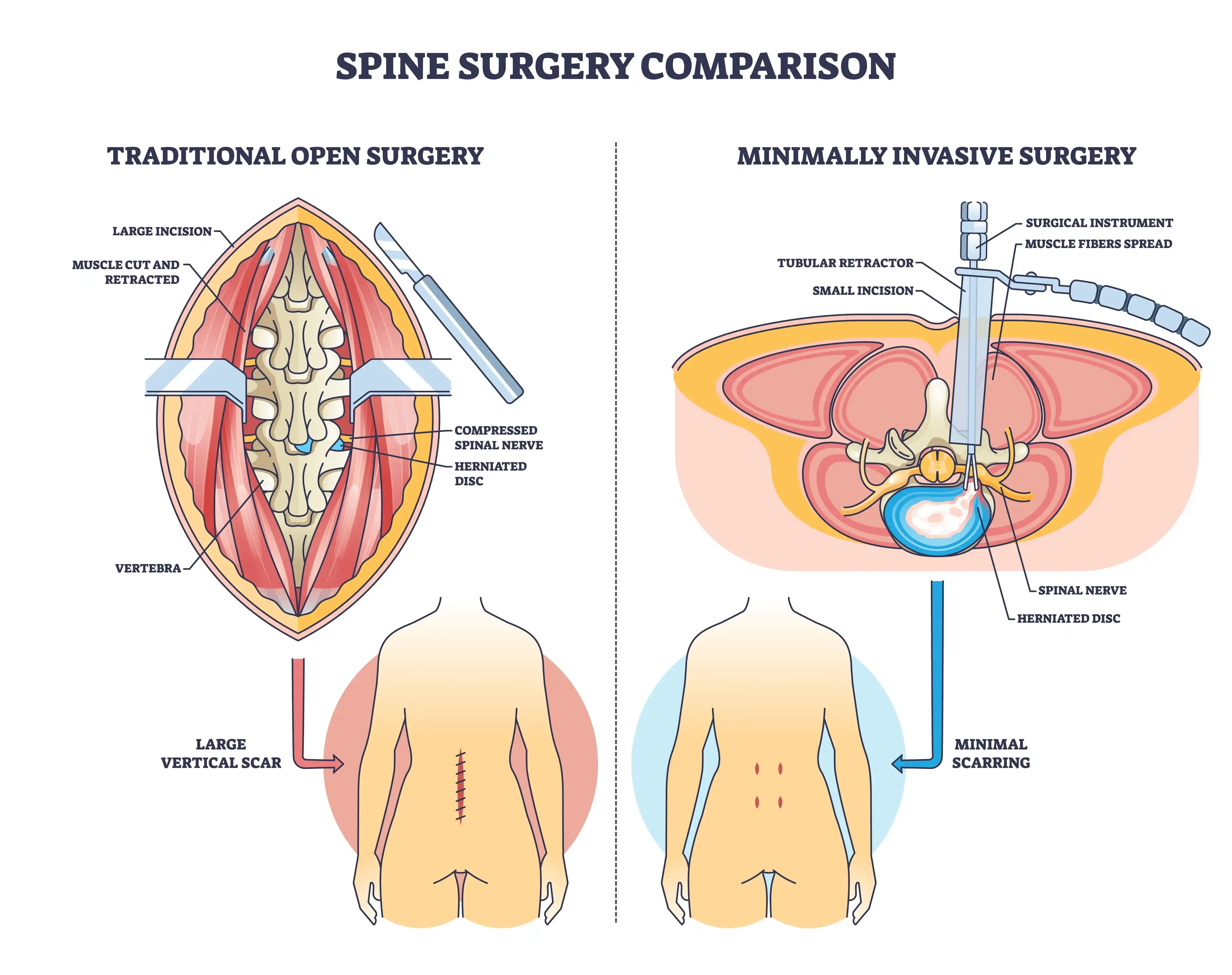Spine-Surgery