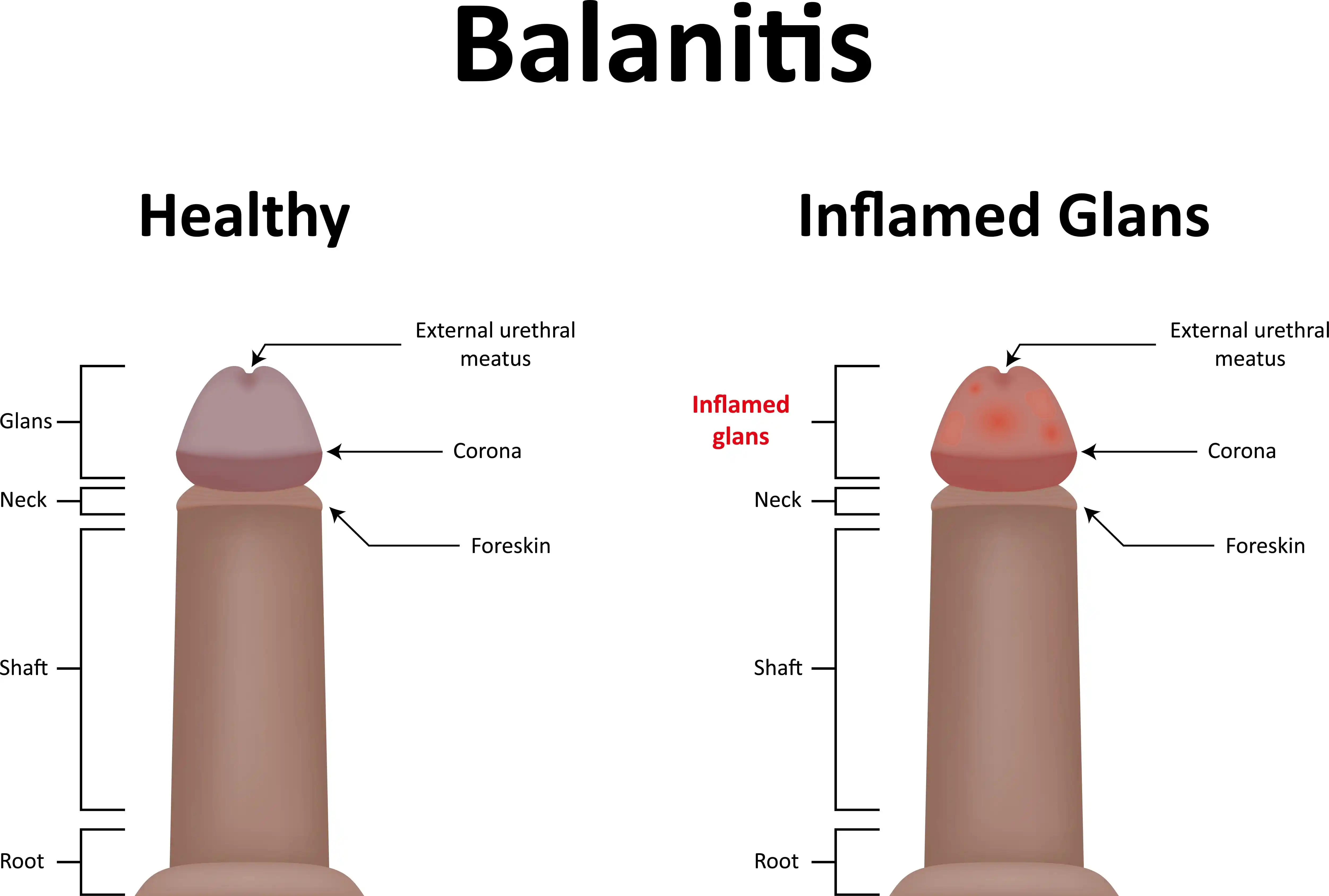 Balanitis