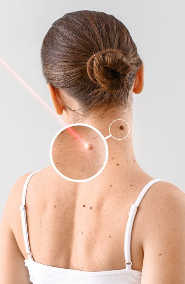 Overview of Burns and Stretch Marks