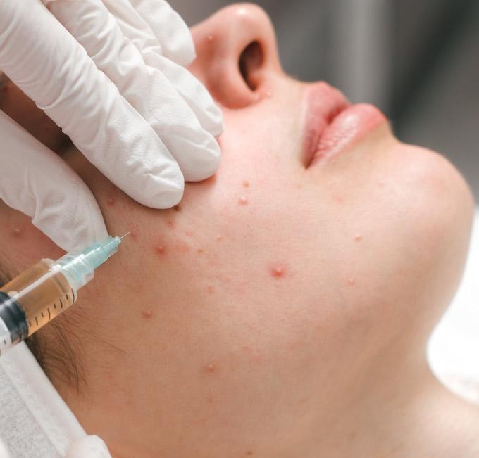 Acne Treatment Journey