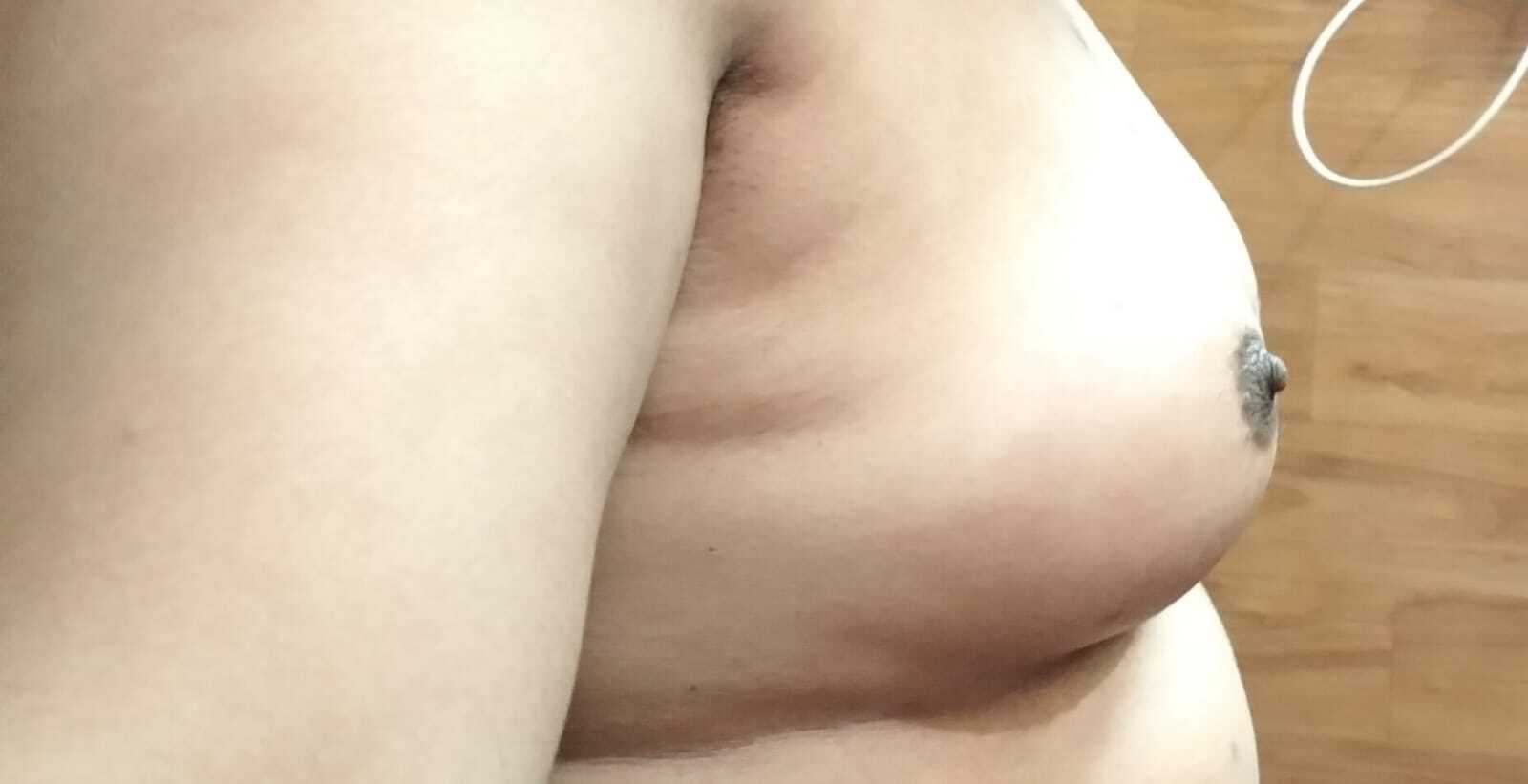 Male patient chest side view showing gynecomastia with pronounced breast projection