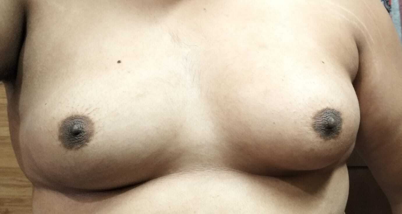 Frontal view of male chest displaying bilateral gynecomastia with enlarged breast tissue