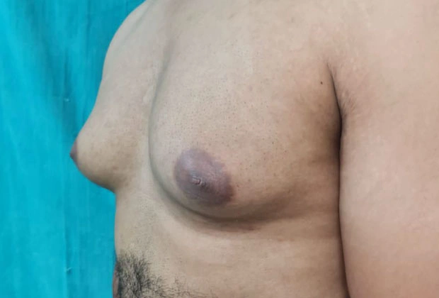 Male chest oblique view highlighting gynecomastia with excess glandular tissue