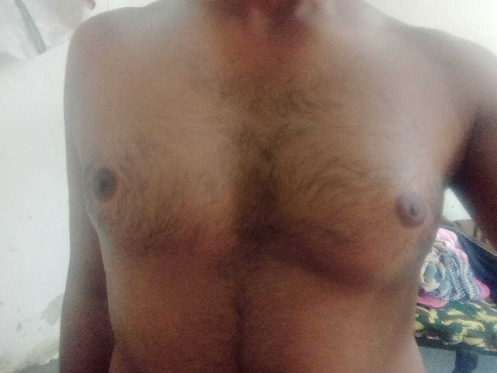 Male patient chest showing mild to moderate gynecomastia with visible breast enlargement