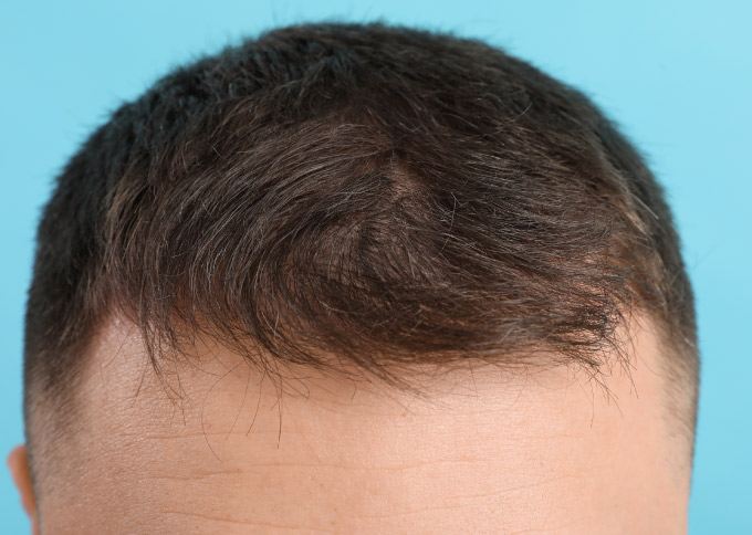 After treatment 1