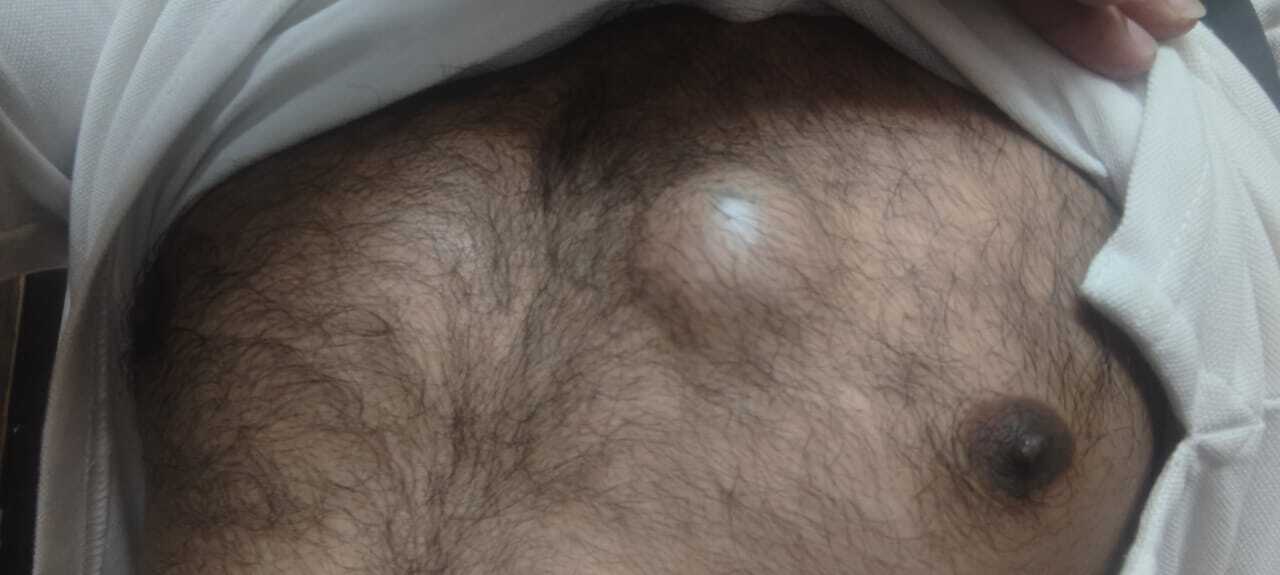 Male patient chest showing localized swelling consistent with benign soft tissue lump