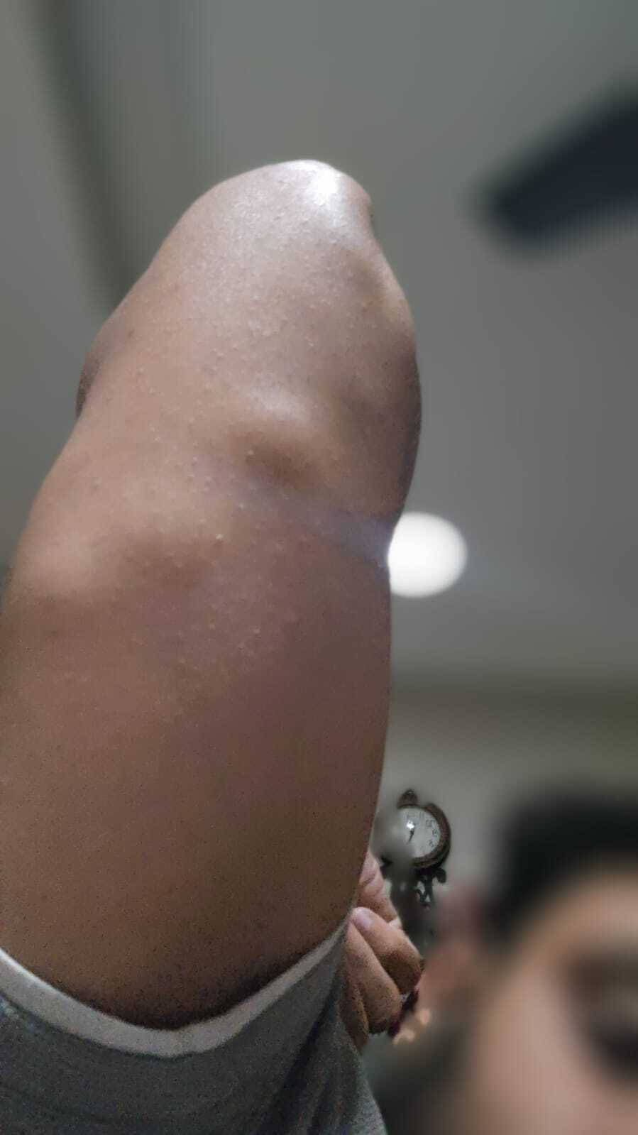 Patient arm displaying prominent subcutaneous lump suggestive of lipoma