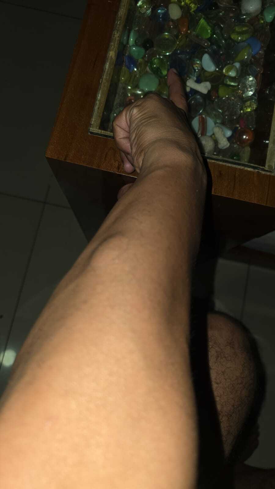 Forearm and Leg Soft Tissue Lumps – Clinical Photos