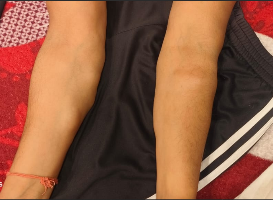 Subcutaneous Arm and Leg Swellings: Patient Images