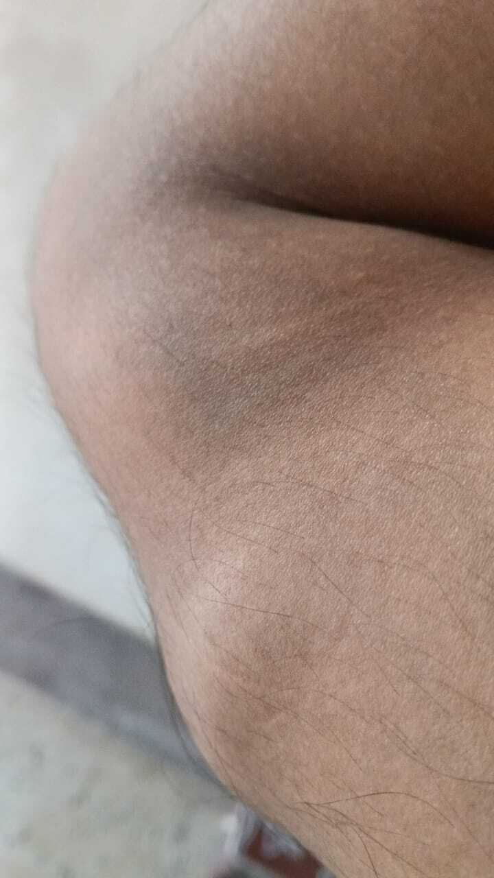 Forearm soft‑tissue swellings consistent with lipomas.
