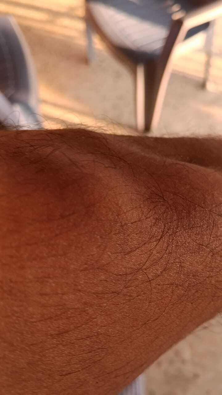 Bilateral leg lumps showing subcutaneous lipomas.
