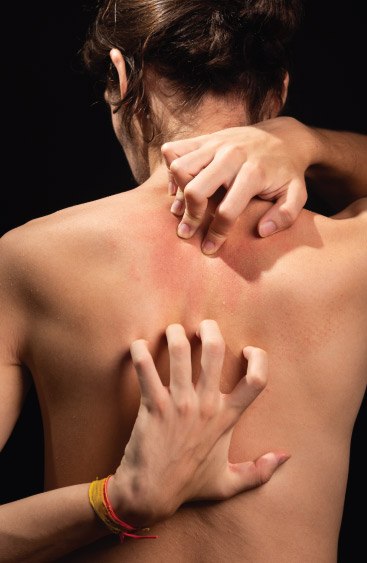 Overview of Psoriasis