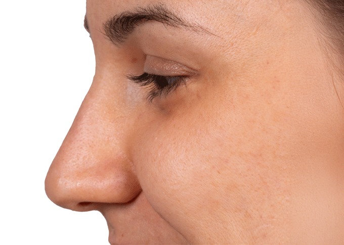 After treatment 2